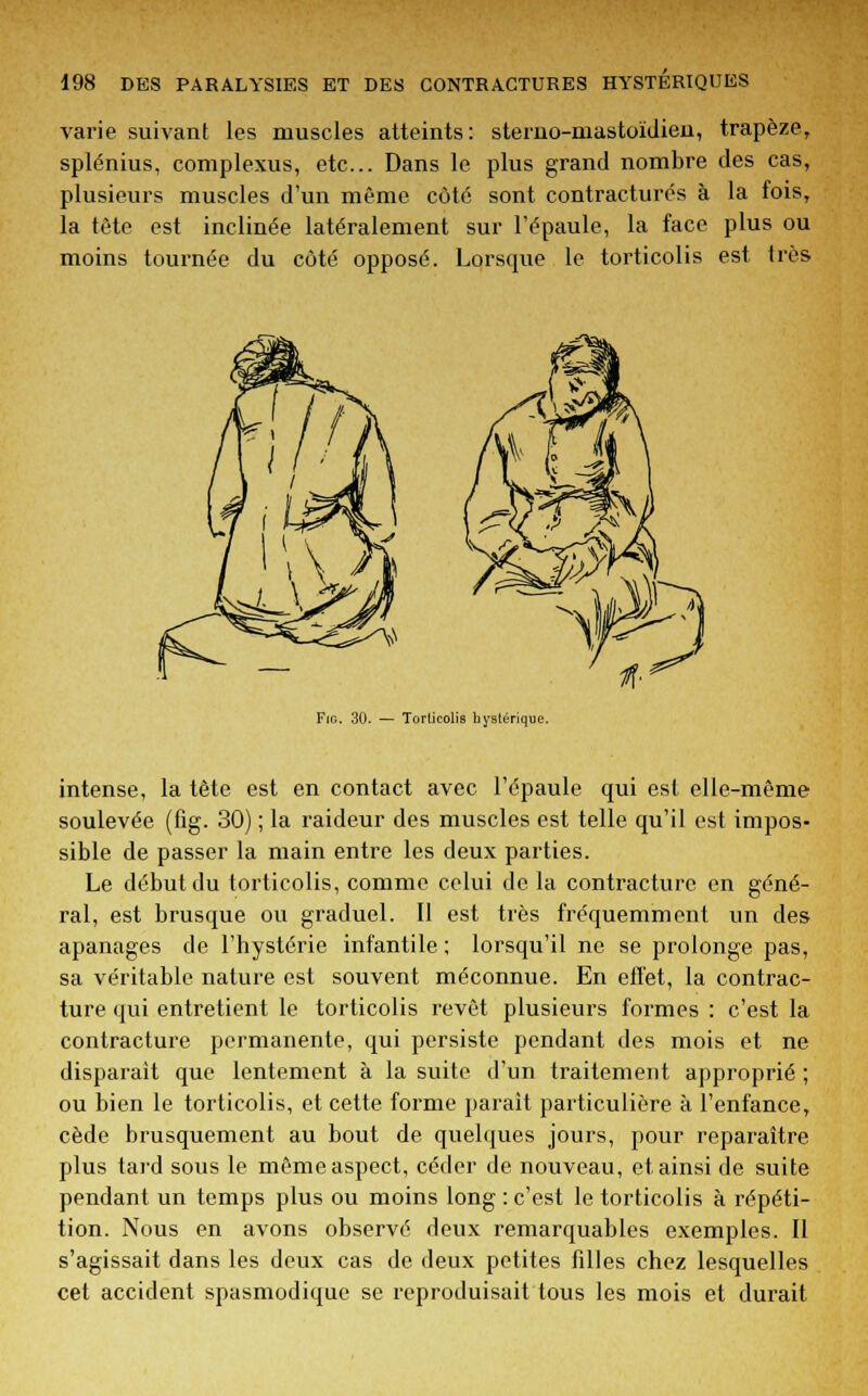 varie suivant les muscles atteints: sterno-mastoïdieu, trapèze, splénius, complexus, etc.. Dans le plus grand nombre des cas, plusieurs muscles d'un même côté sont contractures à la fois, la tète est inclinée latéralement sur l'épaule, la face plus ou moins tournée du côté opposé. Lorsque le torticolis est très Fig. 30. — Torticolis hyslérique. intense, la tète est en contact avec l'épaule qui est elle-même soulevée (fig. 30) ; la raideur des muscles est telle qu'il est impos- sible de passer la main entre les deux parties. Le début du torticolis, comme celui de la contracture en géné- ral, est brusque ou graduel. Il est très fréquemment un des apanages de l'hystérie infantile ; lorsqu'il ne se prolonge pas, sa véritable nature est souvent méconnue. En effet, la contrac- ture qui entretient le torticolis revêt plusieurs formes : c'est la contracture permanente, qui persiste pendant des mois et ne disparait que lentement à la suite d'un traitement approprié ; ou bien le torticolis, et cette forme parait particulière à l'enfance, cède brusquement au bout de quelques jours, pour reparaître plus tard sous le môme aspect, céder de nouveau, et ainsi de suite pendant un temps plus ou moins long : c'est le torticolis à répéti- tion. Nous en avons observé deux remarquables exemples. Il s'agissait dans les deux cas de deux petites fdles chez lesquelles cet accident spasmodique se reproduisait tous les mois et durait