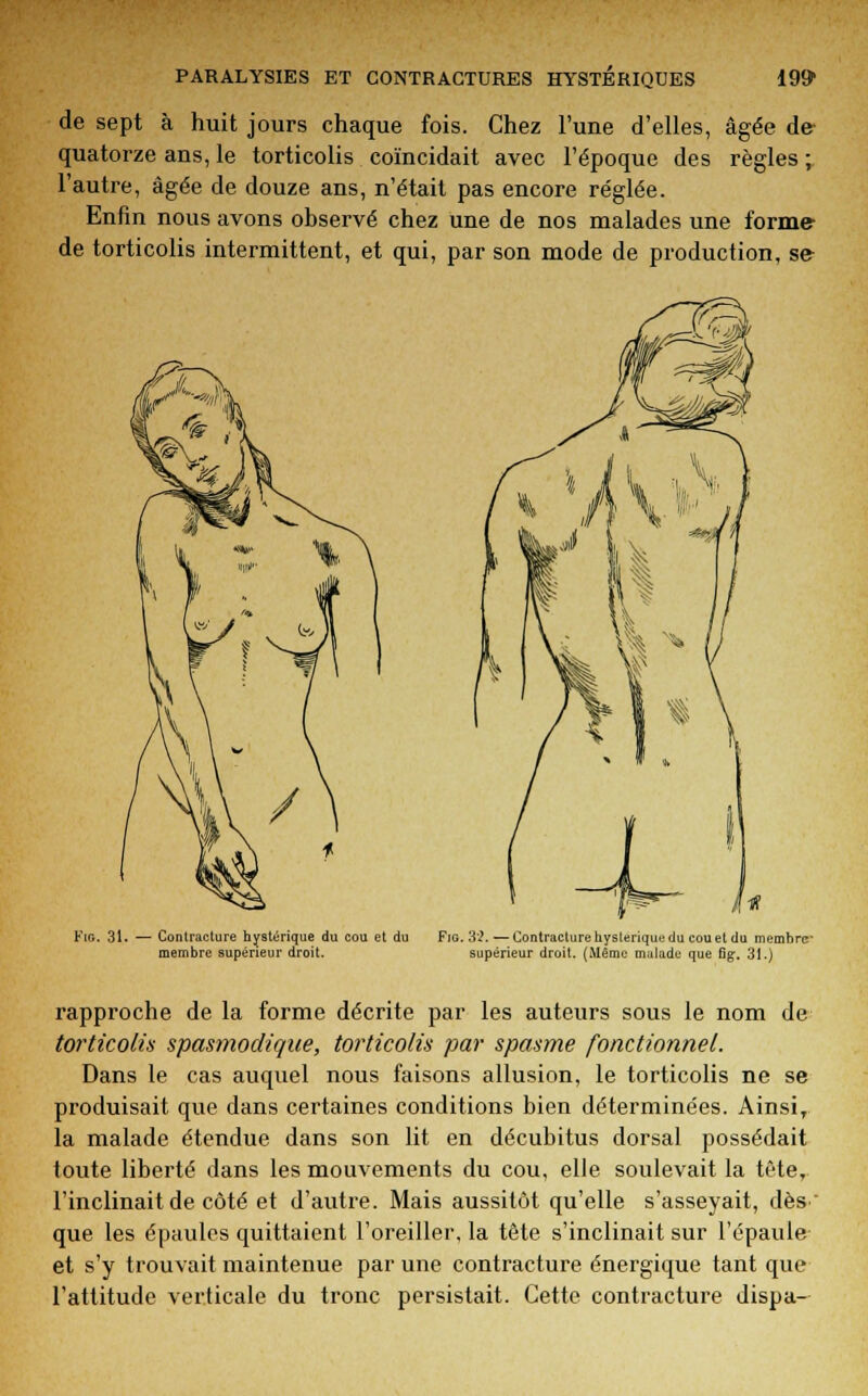 de sept à huit jours chaque fois. Chez l'une d'elles, âgée de- quatorze ans, le torticolis coïncidait avec l'époque des règles ; l'autre, âgée de douze ans, n'était pas encore réglée. Enfin nous avons observé chez une de nos malades une forme de torticolis intermittent, et qui, par son mode de production, se Kig. 31. — Contracture hystérique du cou et du Fig. 3*2.—Contracture hystérique du cou et du memhre membre supérieur droit. supérieur droit. (Même malade que Gg. 31.) rapproche de la forme décrite par les auteurs sous le nom de torticolis spasmodique, torticolis par spasme fonctionnel. Dans le cas auquel nous faisons allusion, le torticolis ne se produisait que dans certaines conditions bien déterminées. Ainsi, la malade étendue dans son lit en décubitus dorsal possédait toute liberté dans les mouvements du cou, elle soulevait la tête, l'inclinait de côté et d'autre. Mais aussitôt qu'elle s'asseyait, dès que les épaules quittaient l'oreiller, la tête s'inclinait sur l'épaule et s'y trouvait maintenue par une contracture énergique tant que l'attitude verticale du tronc persistait. Cette contracture dispa-
