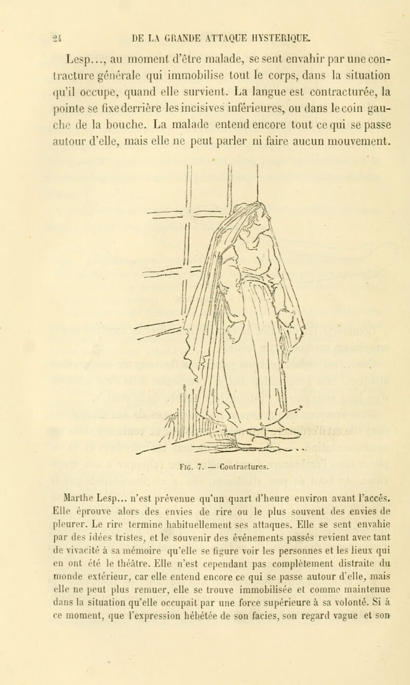 Lesp..., au moment d'être malade, se sent envahir par une con- tracture générale qui immobilise tout le corps, dans la situation qu'il occupe, quand elle survient. La langue est conlracturée, la pointe se llxederrière les incisives inférieures, ou dans lecoin gau- che île la bouche. La malade entend encore tout ce qui se passe autour d'elle, mais elle ne peut parler ni faire aucun mouvement. Contractures. Marthe Lesp... n'est prévenue qu'un quart d'heure environ avant l'accès. Elle éprouve alors des envies de rire ou le plus souvent des envies de pleurer. Le rire termine habituellement ses attaques. Elle se sent envahie par des idées tristes, et le souvenir des événements passés revient avec tant de vivacité à sa mémoire qu'elle se figure voir les personnes et les lieux qui en ont été le théâtre. Elle n'est cependant pas complètement distraite du monde extérieur, car elle entend encore ce qui se passe autour d'elle, mais elle ne peut plus remuer, elle se trouve immobilisée et comme maintenue dans la situation qu'elle occupait par une force supérieure à sa volonté. Si à ce moment, que l'expression hébétée de son faciès, son regard vague et son