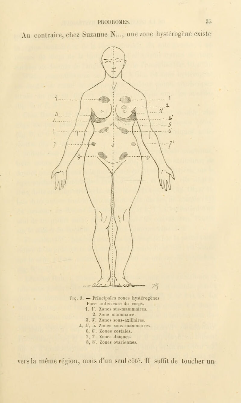 Au contraire, chez Suzanne N..., une zone hystérogène existe l'i',. 3. — Principales zones hystcrogènes l ■ ■ antérieure du corps. il. Zones sus-mammaires. -J. Zone mammaire. 3, 3'. Zones sous-axillaire>. •i. i. 5. Zones sous-mammaires. Zones costales. T. 7 . Zones iliaques. 8, 8'. Zones ovariennes. vers la même région, mais d'un seul coté. Il suffit de toucher un