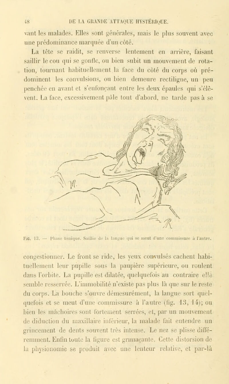 vantles malades. Elles sonl générales, mais le plus souvent avec une prédominance marquée d'un côté. La tête se raidit, se renverse lentement eu arrière, faisant saillir le cou qui se gonfle, ou bien subit un mouvement de rota- tion, tournant habituellement la face du côté du corps où pré- dominent les convulsions, ou bien demeure rectiligne, un peu penchée en avant et s'enfonçant entre les deux épaules qui s'élè- vent. La face, excessivement pâle tout d'abord, ne tarde pas à se FiG. 13. — Phase tunique. Saillie de la langue qui se meut d'une commissure .1 l'autre. congestionner. Le front se ride, les yeux convulsés cachenl habi- tuellement leur pupille sous la paupière supérieure, ou roulent dans l'orbite. La pupille est dilatée, quelquefois au contraire elle semble ressi rrée. L'immobilité n'existe pas plus là que sur le reste du corps. La bouche s'ouvre démesurément, la langue sort quel- quefois et se meut d'une commissure à l'autre <fi;.r. 13, I i); ou bien les mâchoires sont fortement serrées, et, par un mouvement de diduction du maxillaire inférieur, la malade l'ait entendre un grincement de dents souvent très intense. Le nez se plisse diffé- remment. Enfin toute la figure est grimaçante. Cette distorsion de la physionomie se produit avec une lenteur relative, et par-là
