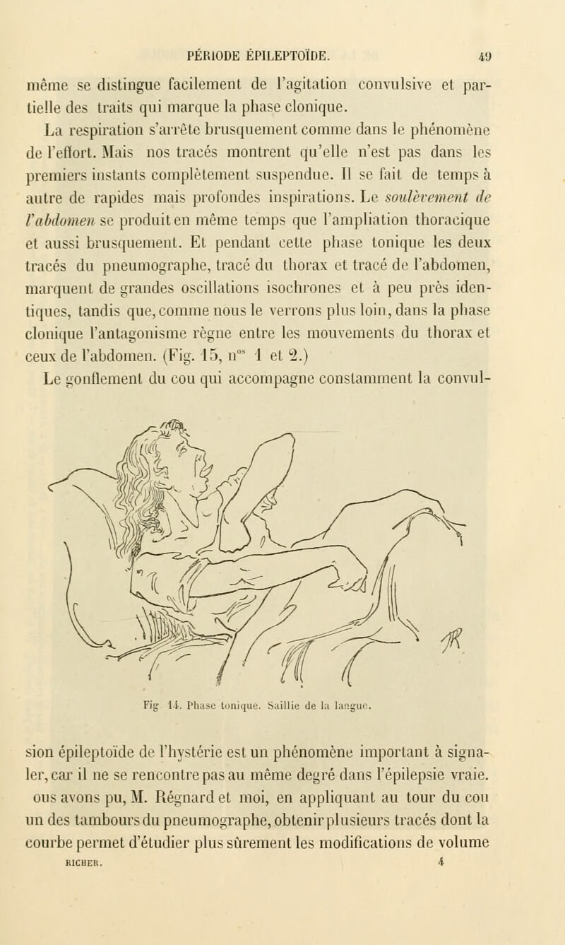 même se distingue facilement de l'agitation convulsive et par- tielle des traits qui marque la phase clonique. La respiration s'arrête brusquement comme dans le phénomène de l'effort. Mais nos tracés montrent qu'elle n'est pas dans les premiers instants complètement suspendue. Il se fait de temps à autre de rapides mais profondes inspirations. Le soulèvement de l'abdomen se produit en même temps que l'ampliation thoracique et aussi brusquement. Et pendant cette phase tonique les deux tracés du pneumographe, tracé du thorax et tracé de l'abdomen, marquent de grandes oscillations isochrones et à peu près iden- tiques, tandis que, comme nous le verrons plus loin, dans la phase clonique l'antagonisme règne entre les mouvements du thorax et ceux de l'abdomen. (Fig. 15, nos I et 2.) Le gonflement du cou qui accompagne constamment la convul- Fig U. Phase tonique. Saillie de la langue. sion épileptoïde de l'hystérie est un phénomène important à signa- ler, car il ne se rencontre pas au même degré dans l'épilepsie vraie, ous avons pu, M. Régnardet moi, en appliquant au tour du cou un des tamboursdu pneumographe, obtenir plusieurs tracés dont la courbe permet d'étudier plus sûrement les modifications de volume