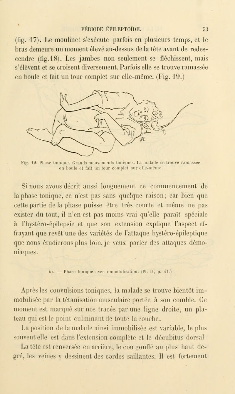 (fig. 17). Le moulinet s'exécute parfois en plusieurs temps, et le bras demeure un moment élevé au-dessus de la tète avant de redes- cendre (fig. 18). Les jambes non seulement se fléchissent, mais s'élèvent et se croisent diversement. Parfois elle se trouve ramassée en boule et fait un tour complet sur elle-même. (Fig. 19.) Fig. 19. Phase tonique. Grands mouvements toniques. La malade se trouve ramassée • •il boule et fait un tour complet sur elle-même. Si nous avons décrit aussi longuement ce commencement de la phase tonique, ce n'est pas sans quelque raison; car bien que cette partie de la phase puisse être très courte et même ne pas exister du tout, il n'en est pas moins vrai qu'elle parait spéciale à l'hystéro-épilepsie et que son extension explique l'aspect ef- frayant que revêt une des variétés de l'attaque hystéro-épileptique que nous étudierons plus loin, je veux parler des attaques démo- niaques. b). — Phase tonique avec immobilisation. (PI. Il, p. il.) Après les convulsions toniques, la malade se trouve bientôt im- mobilisée par la tétanisation musculaire portée à son comble. Ce moment est marqué sur nos tracés par une ligne droite, un pla- teau qui est le point culminant de toute la courbe. La position de la malade ainsi immobilisée est variable, le plus souvent elle est dans l'extension complète et le décubitus dorsal La tète est renversée en arrière, le cou gonflé au plus haut de- gré, les veines y dessinent des cordes saillantes. Il est fortement