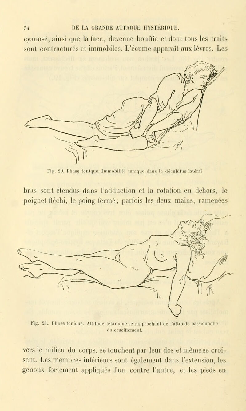 cyanose, ainsi que la face, devenue bouffie et dont tous les traits sont contractures et immobiles. L'écume apparaît aux lèvres. Les Fig. 20. Plinse tonique. Immobilité tonique dans le décubitus latéral. bras sont étendus dans l'adduction et la rotation en dehors, le poignet fléchi, le poing fermé; parfois les deux mains, ramenées Fig. 21. Phase tonique. Altitude tétanique se rapprochant de l'attitude passionnelli du crucifiement. vers le milieu du corps, se touchent par leur dos et même se croi- sent. Les membres inférieurs sont également dans l'extension, les genoux fortement appliqués l'un contre l'autre, et les pieds en