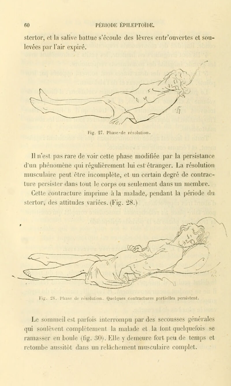 stertor, et la salive battue s'écoule des lèvres entr'ouvertes et sou- levées par l'air expiré. Phase-de résolution. Il n'est pas rare de voir cette phase modifiée par la persistance d'un phénomène qui régulièrement lui est étranger. La résolution musculaire peut être incomplète, et un certain degré de contrac- ture persister dans tout le corps ou seulement dans un membre. Cette contracture imprime à la malade, pendant la période du slertor, des attitudes variées. (Fig. 28.) olution. Quelques contractures partielles persistent. Le sommeil est parfois interrompu par des secousses générales qui soulèvent complètement la malade et la lont quelquefois se ramasser en boule (fig. 30). Elle y demeure fort peu de temps et retombe aussitôt dans un relâchement musculaire complet.