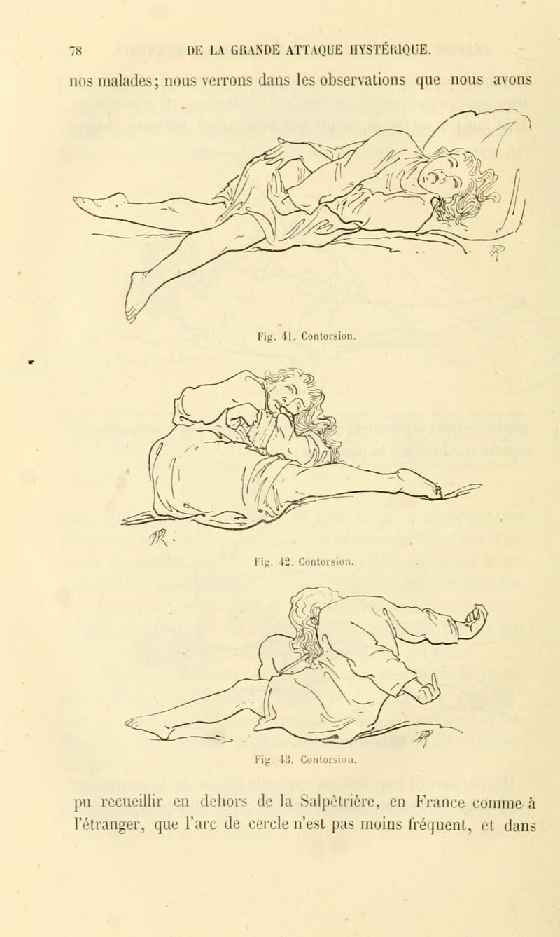 nos malades ; nous verrons dans les observations que nous avons Fiir. 41. Contorsion. Fia 12. Contorsion. pu recueillir en dehors de la Salpêtrière, en France comme à l'étranger, que l'arc de cercle n'est pas inoins fréquent, et dans