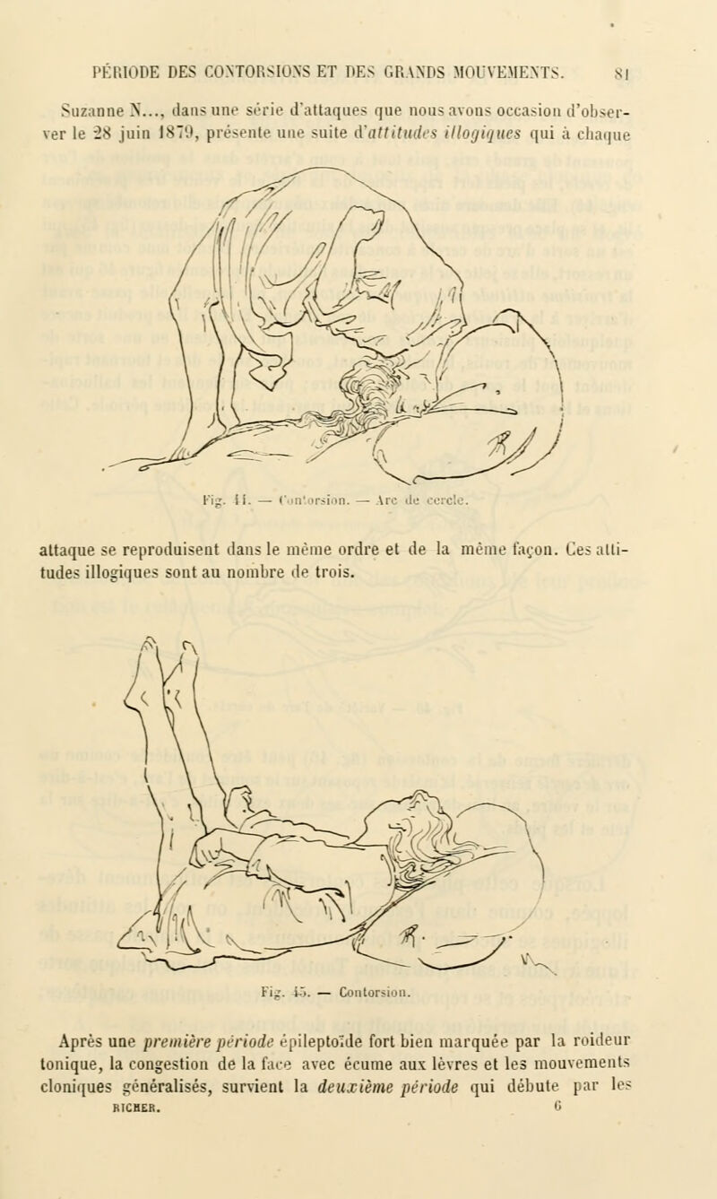 Suzanne N..., dans une série d'attaques que nous avons occasion d'obser- ver le 28 juin 1879, présente une suite d'attitudes illogiques qui à chaque Pi». II. — Contorsion. — Ire d attaque se reproduisent dans le même ordre et de la même façon. Ces alti- tudes illogiques sont au nombre de trois. Fig. 15. — Contorsion. Après une première période épileptoïde fort bien marquée par la roideur tonique, la congestion de la face avec écume aux lèvres et les mouvements cloniques généralisés, survient la deuxième période qui débute par les MCHER. o