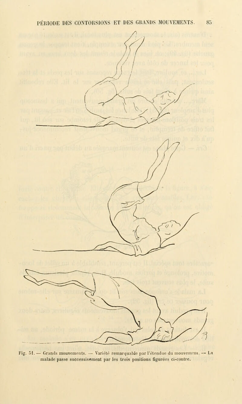 Fig. 51. — Grands mouvements. — Variété remarquable par l'étendue du mouvement, — La malade passe successivement par les trois positions figurées ci-contre.