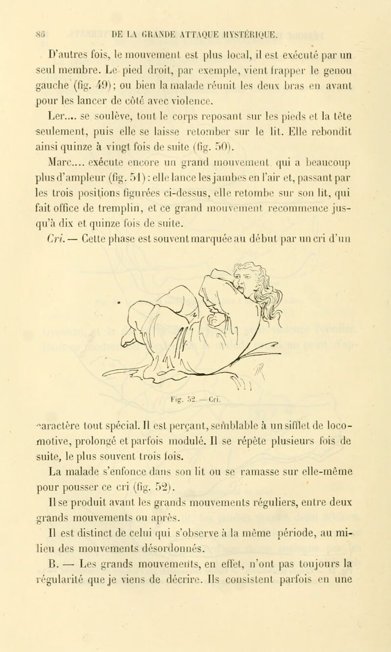 D'autres fois, lemouveraenl est plus local, ilesl exécuté par un seul membre. Le pied droit, par exemple, vienl frapper le genou gauche (fig. Ï9); ou bien la malade réunit les deux bras en avant pour les lancer de côté avec violence. Ler.... se soulève, toul le corps reposant sur les pieds et la tète seulement, puis elle se laisse retomber sur le lit. Elle rebondit ainsi quinze à vingt fois de suite (fig. 50). Marc... exécute encore un grand mouvement qui a beaucoup plus d'ampleur (fig. 51) : elle lance les jambes en l'air et, passant par les trois positions figurées ci-dessus, elle retombe sur son lit, qui fait office de tremplin, et ce grand mouvement recommence jus- qu'à dix et quinze fois de suite. Cri.— Cette phase est souvent marquée au début par un cri d'un Fiff. 52 —Cri. aractère tout spécial. Il est perçant, semblable à un sifflet de loco- motive, prolongé et parfois modulé. Il se répète plusieurs ibis de suite, le plus souvent trois fois. La malade s'enfonce dans son lit ou se ramasse sur elle-même pour pousser ce cri (fig. .V2). Use produit avant l'es grands mouvements réguliers, entre deux grands mouvements ou après. Il est distinct de celui qui s'observe à la même période, au mi- lieu des mouvements désordonnés. B. — Les grands mouvements, en effet, n'ont pas toujours la régularité que je viens de décrire. Ils consistent parfois en une