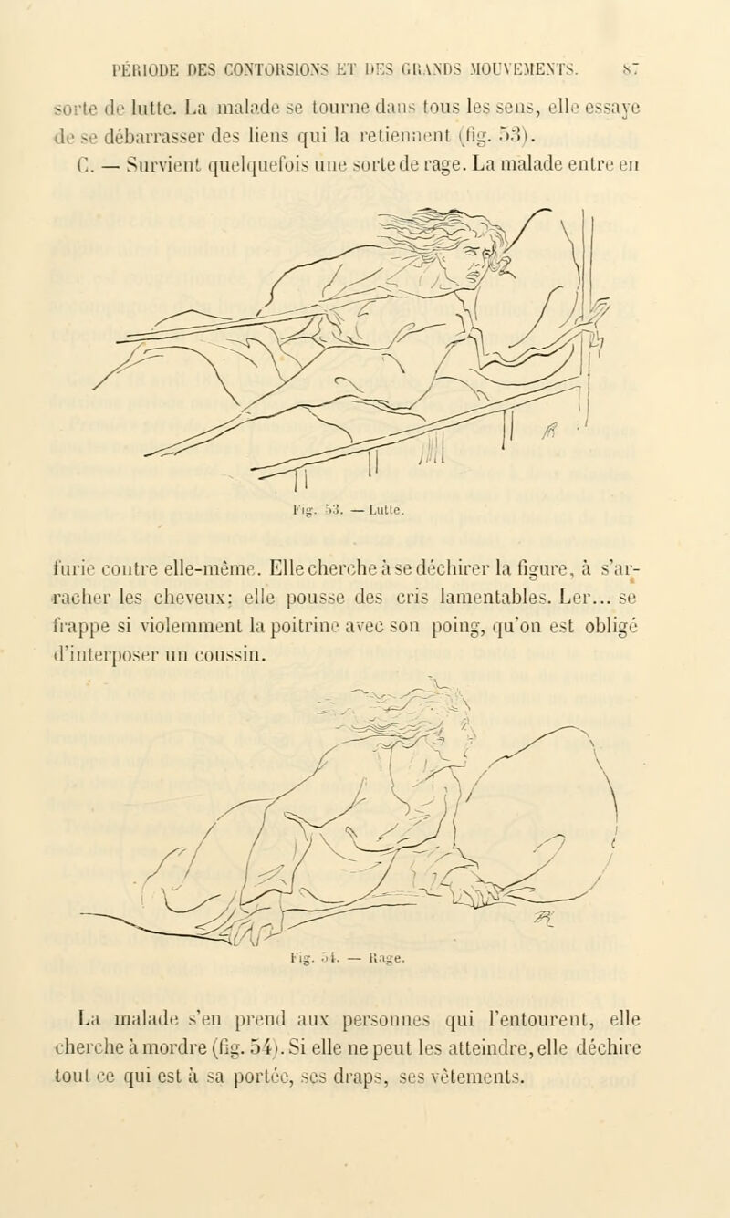 sorte de lutte. La malade se tourne dans tous les sens, elle essaye de se débarrasser des liens qui la retiennent (fig. 53). C. — Survient quelquefois une sortede rage. La malade entre en furie coutre elle-même. Elle cherche à se déchirer la figure, à s'ar- racher les cheveux: elle pousse des cris lamentables. Ler... se frappe si violemment la poitrine avec son poing, qu'on est obligé d'interposer un coussin. La malade s'en prend aux personnes qui l'entourent, elle cherche à mordre (dg.. 54). Si elle ne peut les atteindre, elle déchire tout ce qui est à sa portée, ses draps, ses vêtements.