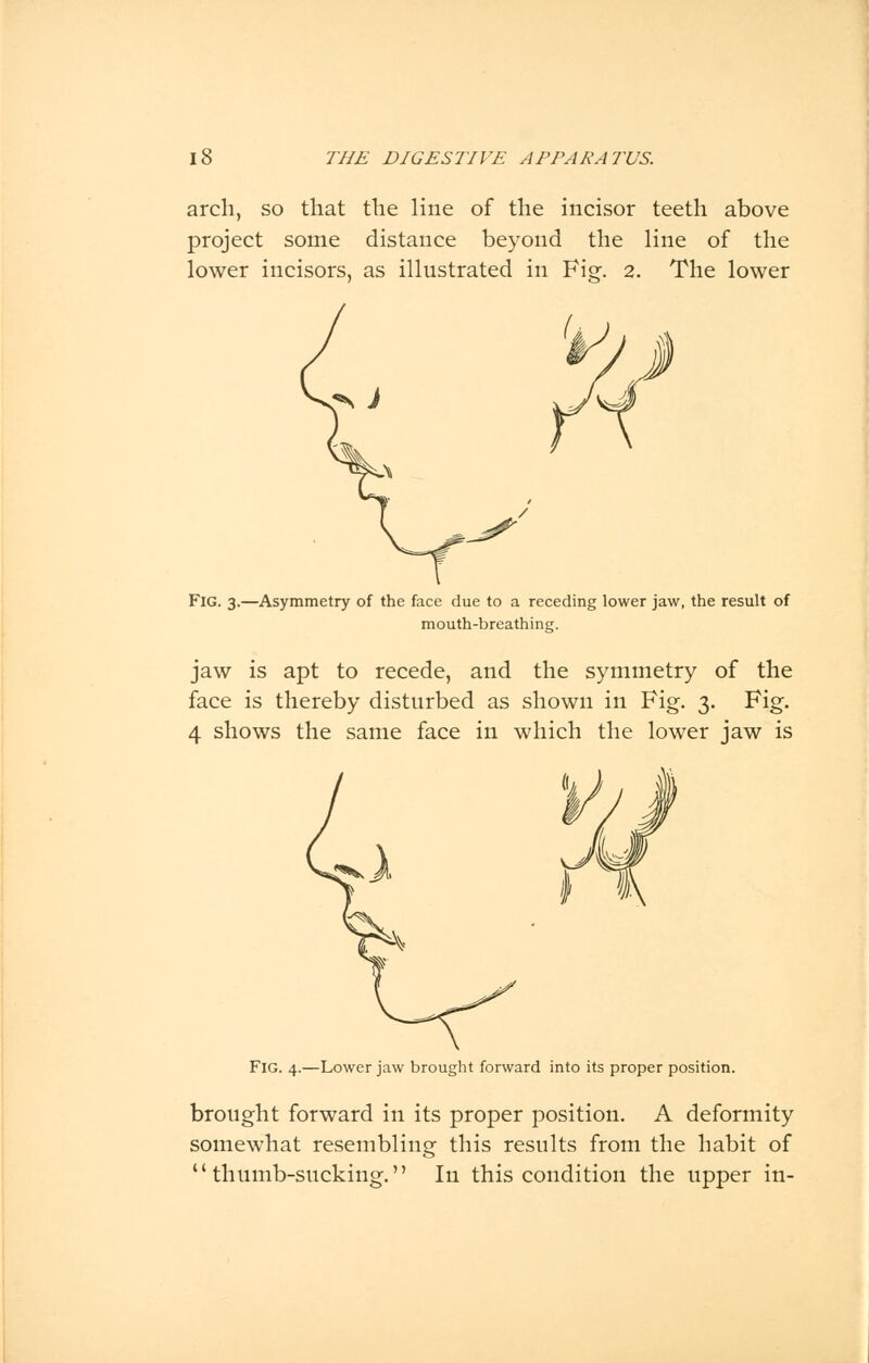 arch, so that the line of the incisor teeth above project some distance beyond the line of the lower incisors, as illustrated in Fig. 2. The lower Fig. 3.—Asymmetry of the face due to a receding lower jaw, the result of mouth-breathing. jaw is apt to recede, and the symmetry of the face is thereby disturbed as shown in Fig. 3. Fig. 4 shows the same face in which the lower jaw is Fig. 4.—Lower jaw brought forward into its proper position. brought forward in its proper position. A deformity somewhat resembling this results from the habit of thumb-sucking. In this condition the upper in-