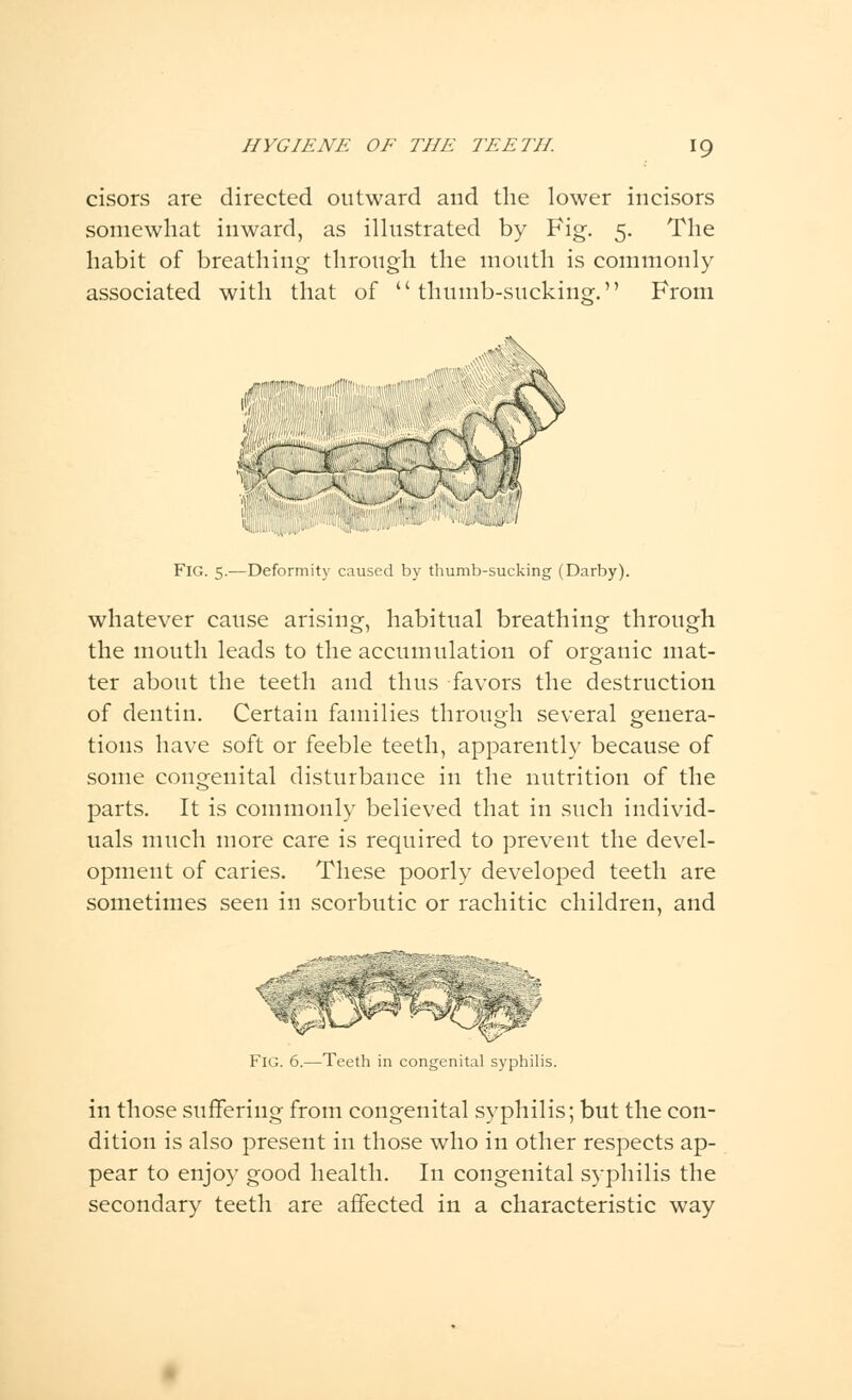 w::-« cisors are directed outward and the lower incisors somewhat inward, as illustrated by Fig. 5. The habit of breathing through the mouth is commonly associated with that of thumb-sucking. From te^pffttlllffliwa^l® V..-V; 'V Jf Fig. 5.—Deformity caused by thumb-sucking (Darby). whatever cause arising, habitual breathing through the mouth leads to the accumulation of organic mat- ter about the teeth and thus favors the destruction of dentin. Certain families through several genera- tions have soft or feeble teeth, apparently because of some congenital disturbance in the nutrition of the parts. It is commonly believed that in such individ- uals much more care is required to prevent the devel- opment of caries. These poorly developed teeth are sometimes seen in scorbutic or rachitic children, and Fig. 6.—Teeth in congenital syphilis. in those suffering from congenital syphilis; but the con- dition is also present in those who in other respects ap- pear to enjoy good health. In congenital syphilis the secondary teeth are affected in a characteristic way