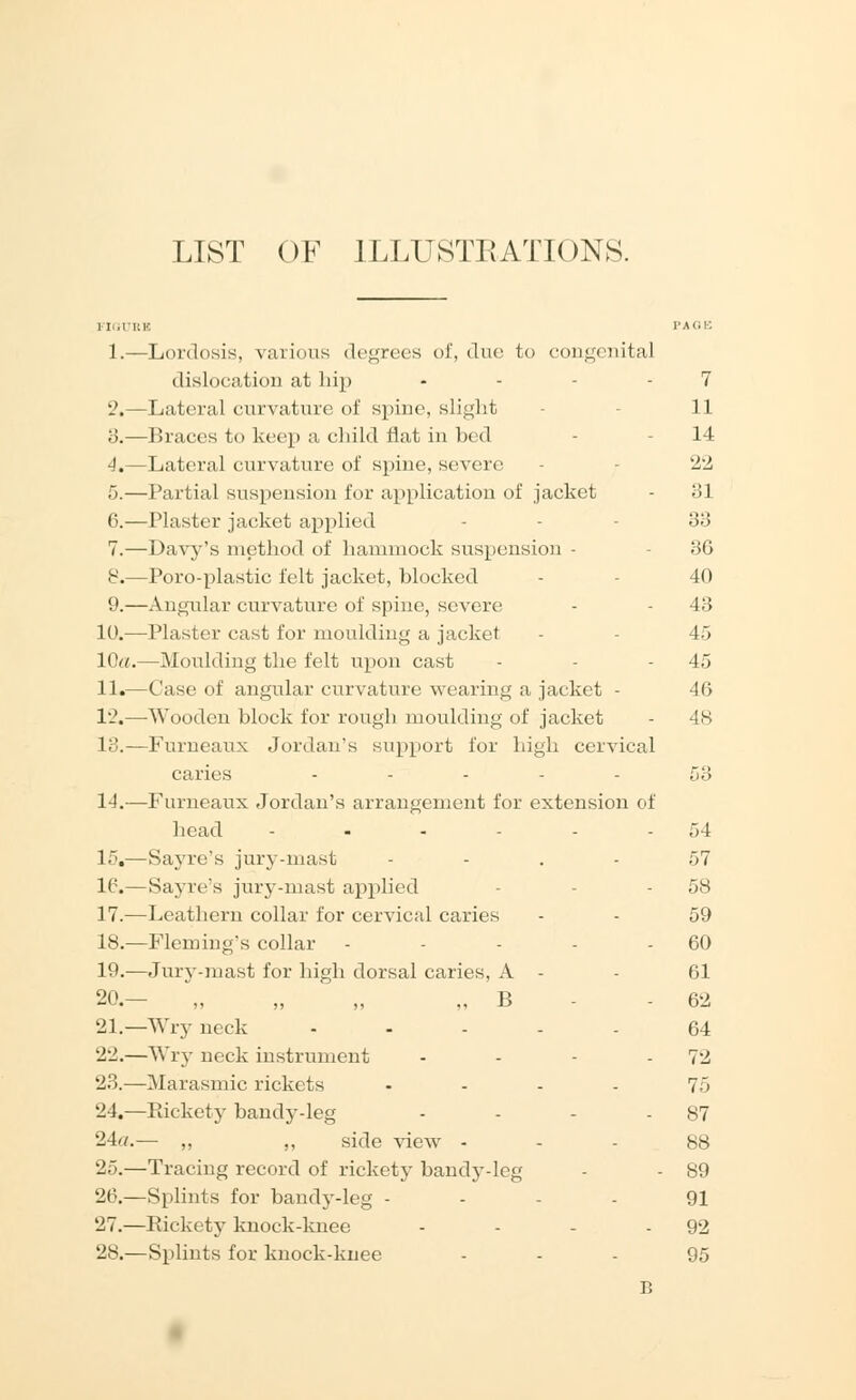 LIST OF ILLUSTRATIONS. 1.—Lordosis, various degrees of, duo to congenital dislocation at hip - - 7 2.—Lateral curvature of spine, slight 11 3.—Braces to keep a child flat in bed - 14 4.—Lateral curvature of spine, severe - 22 5.—Partial suspension for application of jacket - 31 6.—Plaster jacket applied - 33 7.—Davy's method of hammock suspension - 36 8.—Poro-plastic felt jacket, blocked 40 9.—Angular curvature of spine, severe - - 43 10.—Plaster cast for moulding a jacket - 45 10«.—Moulding the felt upon cast - - 45 11.—Case of angular curvature wearing a jacket - 40 12.—Wooden block for rough moulding of jacket - 48 13.—Furneaux Jordan's support lor high cervical caries ----- 53 14.—Furneaux Jordan's arrangement for extension of head ... - - 54 15.—Sayrc's jury-mast 57 16.—Sayre's jury-mast applied - 58 17.—Leathern collar for cervical caries - - 59 18.—Fleming's collar - 60 19.—Jury-mast for high dorsal caries, A - 61 20.— „ „ „ B 62 21.—Wryneck ..... 64 22.—Wry neck instrument - - - - 72 23.—Marasmic rickets .... 75 24.—Rickety bandy-leg - - - - 87 24a.— „ ,, side view 88 25.—Tracing record of rickety bandy-leg - - 89 26.—Splints for bandy-leg - ... 91 27.—Bickety knock-knee - - - - 92 28.—Splints for knock-knee 95 B