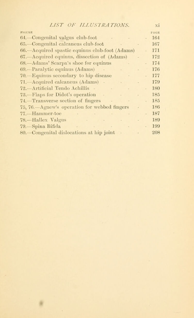 F10UUB PAGE 64. Congenital valgus club-foot - 164 65.—Congenita] calcaneus club-foot 167 66.—Acquired spastic equinus club-foot (Adams) 171 67.—Acquired equinus, dissection of (Adams) - 172 68.—Adams' Scarpa's shoe for equinus - 174 69.—Paralytic equinus (Adams) - 176 70.—Equinus secondary to hip disease 177 71.—Acquired calcaneus (Adams) 179 72.—Artificial Tendo Adiillis - 180 73.— Flaps for Didot's operation - 185 74.—Transverse section of fingers - - 185 75, 76.—AgneVs operation for webbed fingers - 186 77.—Hammer-toe - 187 78.—Hal lex Valgus 189 79.—Spina Bifida - 199 80.—Congenital dislocations at hip joint 208