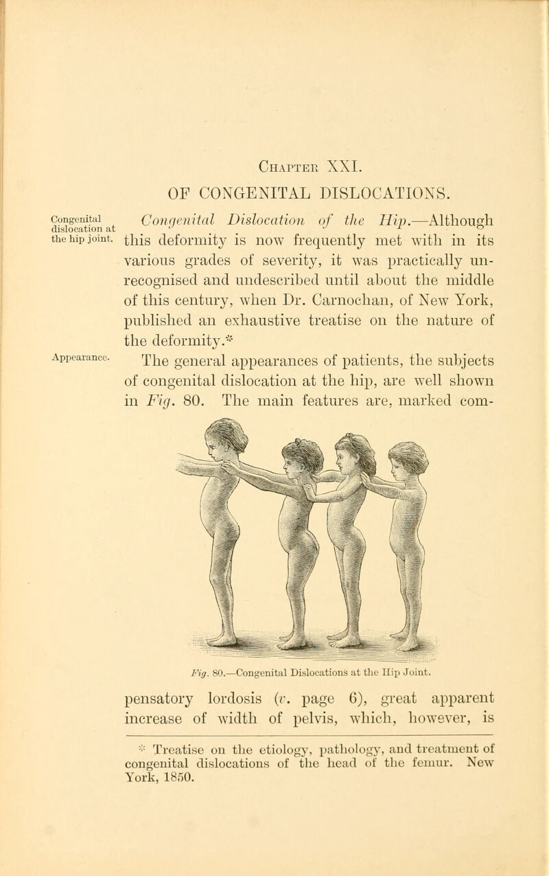 Chapter XXI. OF CONGENITAL DISLOCATIONS. Congenital Conqenital Dislocation of the Hip.—Although dislocation at ''  -1 ° the Mp joint, this deformity is now frequently met with in its various grades of severity, it was practically un- recognised and undescribed until about the middle of this century, when Dr. Carnochan, of New York, published an exhaustive treatise on the nature of the deformity.'-' Appearance. Th.e general appearances of patients, the subjects of congenital dislocation at the hip, are well shown in Fig. 80. The main features are, marked COm- ^ty. SO.—Congenital Dislocations at the Hip Joint. pensatory lordosis (v. page 6), great apparent increase of width of pelvis, which, however, is * Treatise on the etiology, pathology, and treatment of congenital dislocations of the head of the femur. New York, 1850.