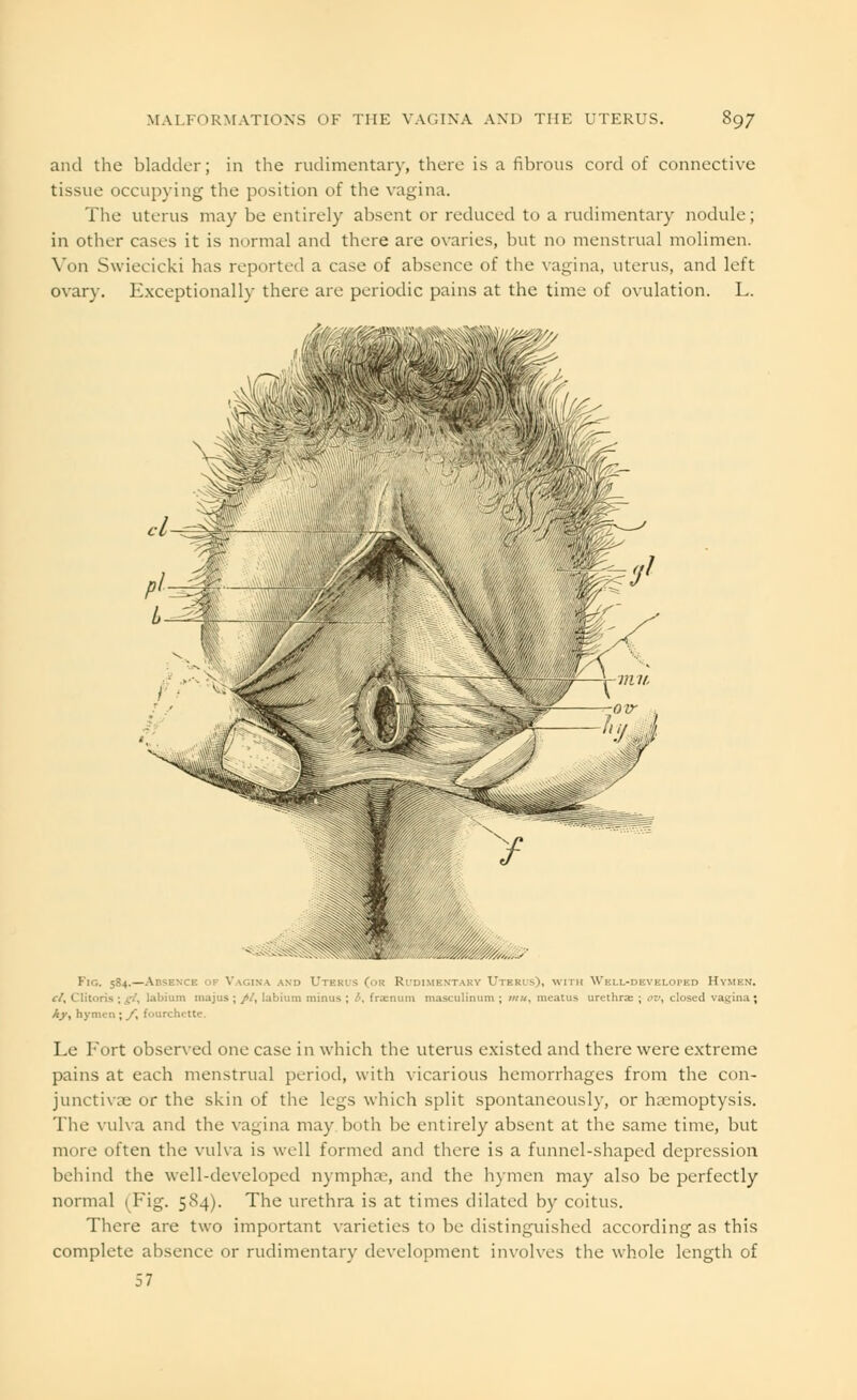 and the bladder; in the rudimentary, there is a fibrous cord of connective tissue occupying the position of the vagina. The uterus may be entirely absent or reduced to a rudimentary nodule; in other cases it is normal and there are ovaries, but no menstrual molimen. Von Swiecicki has reported a case of absence of the vagina, uterus, and left ovary. Exceptionally there are periodic pains at the time of ovulation. L. ■ Fig. 584.—Absence of Vagina and Uteris (int. Rudimentary Uterus), with Well-developed Hymen. el, Clitoris ; gi, labium inajus ; //, labium minus ; i, frjenum masculinum ; mu, meatus urethra; ; ov, closed vagina ; Ay, hymen ; /, fourchette. Le Fort observed one case in which the uterus existed and there were extreme pains at each menstrual period, with vicarious hemorrhages from the con- junctivae or the skin of the legs which split spontaneously, or haemoptysis. The vulva and the vagina may both be entirely absent at the same time, but more often the vulva is well formed and there is a funnel-shaped depression behind the well-developed nymphae, and the hymen may also be perfectly normal vFig. 584). The urethra is at times dilated by coitus. There are two important varieties to be distinguished according as this complete absence or rudimentary development involves the whole length of 57