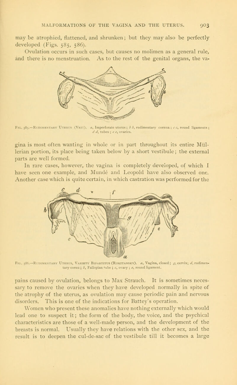 may be atrophied, flattened, and shrunken; but they may also be perfectly developed (Figs. 5S5, 586). Ovulation occurs in such cases, but causes no molimen as a general rule, and there is no menstruation. As to the rest of the genital organs, the va- Fig. 585.—Rudimentary Utki a, Imperforate uterus ; ^ <S, rudimentary cornua ; cc, round ligaments; d ./, tubes ; e .', ovaries. gina is most often wanting in whole or in part throughout its entire Miil- lerian portion, its place being taken below by a short vestibule; the external parts are well formed. In rare cases, however, the vagina is completely developed, of which I have seen one example, and Munde and Leopold have also observed one. Another case which is quite certain, in which castration was performed for the Fig. 586.—Rudimentary Uteris, Variety BipartttuS (Rokitansky). a. Vagina, closed ; g; cervix; (/.rudimen- tary cornu ; i, Fallopian rube ; c, ovary ; e, round ligament. pains caused by ovulation, belongs to Max Strauch. It is sometimes neces- sary to remove the ovaries when they have developed normally in spite of the atrophy of the uterus, as ovulation may cause periodic pain and nervous disorders. This is one of the indications for Battey's operation. Women who present these anomalies have nothing externally which would lead one to suspect it; the form of the body, the voice, and the psychical characteristics are those of a well-made person, and the development of the breasts is normal. Usually they have relations with the other sex, and the result is to deepen the cul-de-sac of the vestibule till it becomes a large