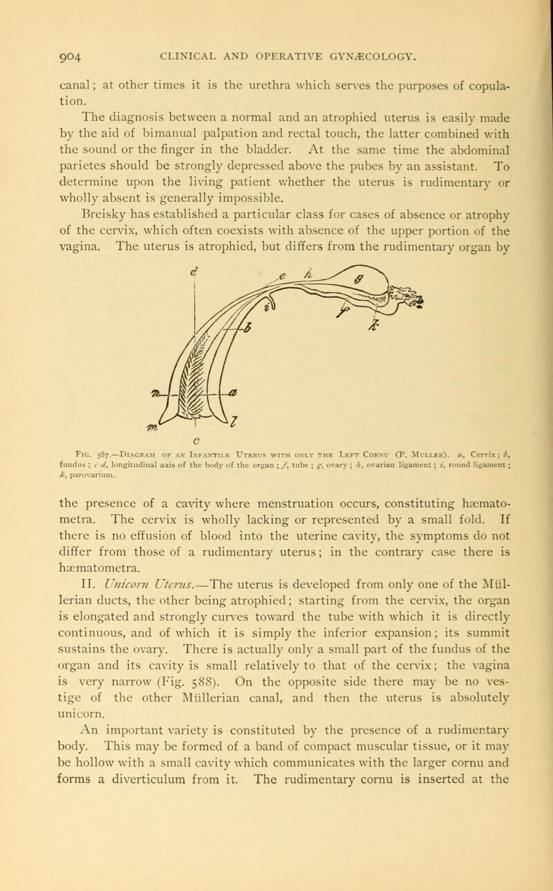 canal; at other times it is the urethra which serves the purposes of copula- tion. The diagnosis between a normal and an atrophied uterus is easily made by the aid of bimanual palpation and rectal touch, the latter combined with the sound or the finger in the bladder. At. the same time the abdominal parietes should be strongly depressed above the pubes by an assistant. To determine upon the living patient whether the uterus is rudimentary or wholly absent is generally impossible. Breisky has established a particular class for cases of absence or atrophy of the cervix, which often coexists with absence of the upper portion of the vagina. The uterus is atrophied, but differs from the rudimentary organ by Fig. 587.—Diagram of an Infantile Uteris with only the Left Corni- (P. Miller), a, Cervix ; i, fundus ; c tt, longitudinal axis of the body of the organ \J\ tube ; g. ovary ; /i, ovarian ligament; /, round ligament; >£, parovarium. the presence of a cavity where menstruation occurs, constituting haemato- metra. The cervix is wholly lacking or represented by a small fold. If there is no effusion of blood into the uterine cavity, the symptoms do not differ from those of a rudimentary uterus; in the contrary case there is haematometra. II. Unicorn Uterus.—The uterus is developed from only one of the Mtil- lerian ducts, the other being atrophied; starting from the cervix, the organ is elongated and strongly curves toward the tube with which it is directly continuous, and of which it is simply the inferior expansion ; its summit sustains the ovary. There is actually only a small part of the fundus of the organ and its cavity is small relatively to that of the cervix; the vagina is very narrow (Fig. 588). On the opposite side there may be no ves- tige of the other Miillerian canal, and then the uterus is absolutely unicorn. An important variety is constituted by the presence of a rudimentary body. This may be formed of a band of compact muscular tissue, or it may be hollow with a small cavity which communicates with the larger cornu and forms a diverticulum from it. The rudimentary cornu is inserted at the
