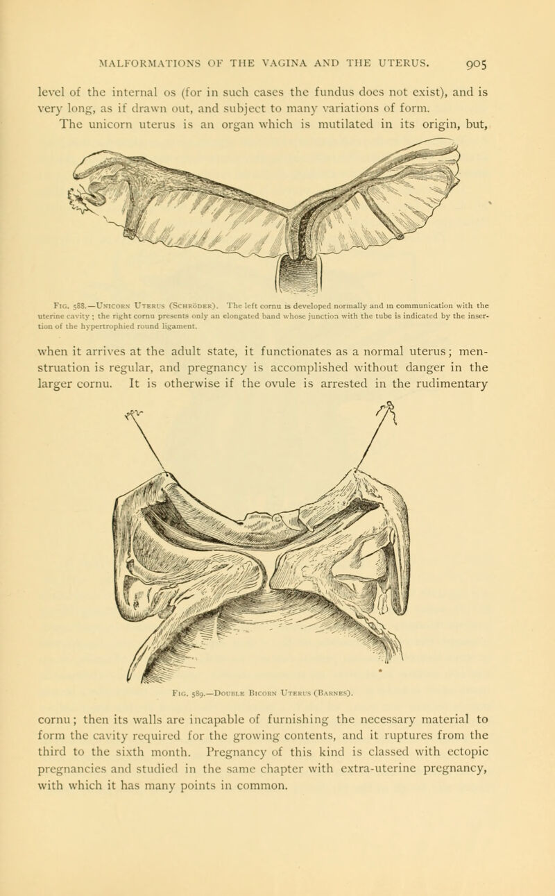 level of the internal OS (for in such cases the fundus does not exist), and is very long, as if drawn out, and subject to many variations of form. The unicorn uterus is an organ which is mutilated in its origin, but, Fig. 5SS.—Unicorn Uteris (Schroder). The left cornu is developed normally and in communication with the uterine cavity ; the right cornu presents only an elongated band whose junction with the tube is indicated by the inser- tion of the hypertrophied round ligament. when it arrives at the adult state, it functionates as a normal uterus; men- struation is regular, and pregnancy is accomplished without danger in the larger cornu. It is otherwise if the ovule is arrested in the rudimentary Fig. 589.—Don.11 1 1 (I!aknes). cornu; then its walls are incapable of furnishing the necessary material to form the cavity required for the growing contents, and it ruptures from the third to the sixth month. Pregnancy of this kind is classed with ectopic pregnancies and studied in the same chapter with extra-uterine pregnancy, with which it has many points in common.