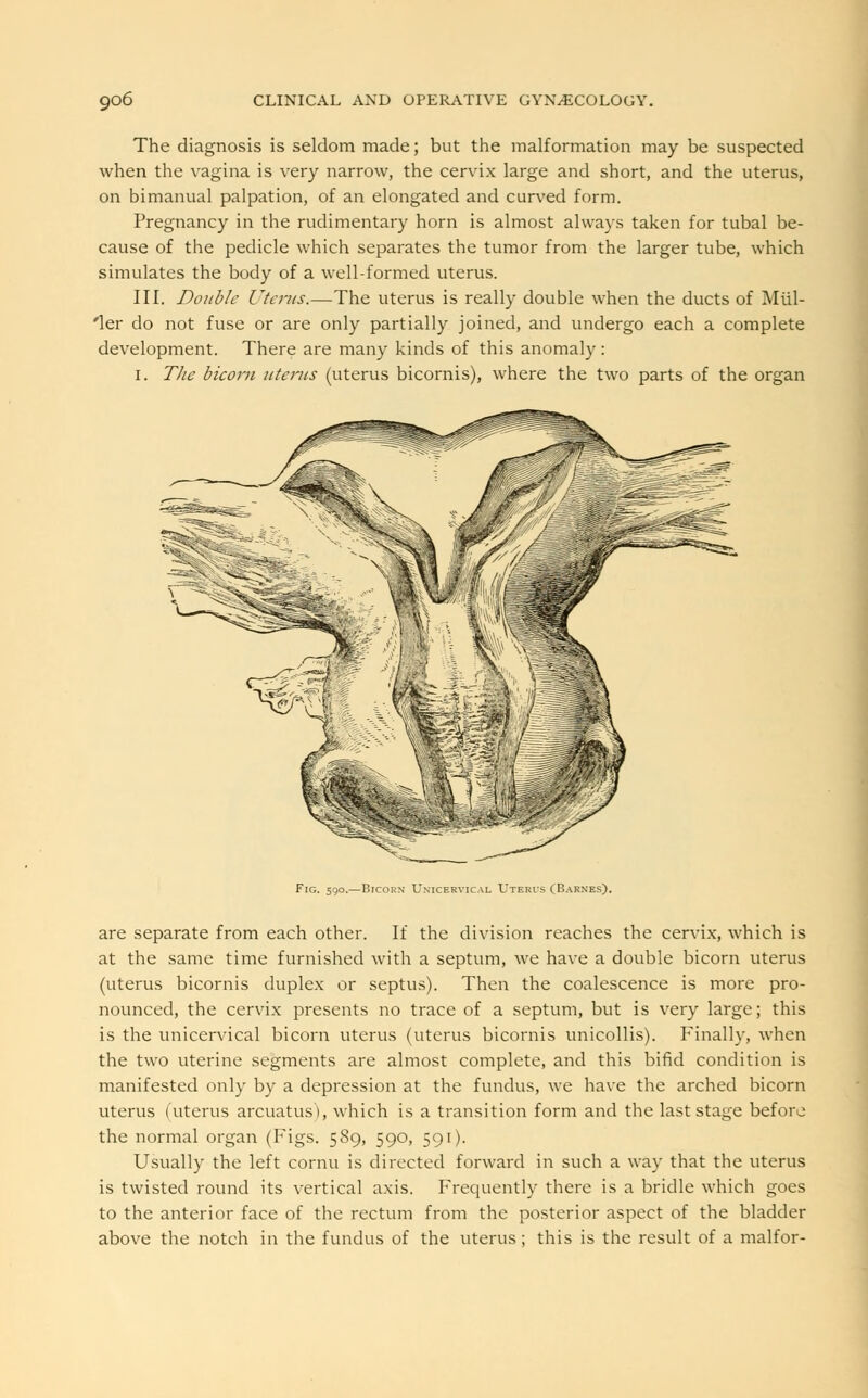 The diagnosis is seldom made; but the malformation may be suspected when the vagina is very narrow, the cervix large and short, and the uterus, on bimanual palpation, of an elongated and curved form. Pregnancy in the rudimentary horn is almost always taken for tubal be- cause of the pedicle which separates the tumor from the larger tube, which simulates the body of a well-formed uterus. III. Double Uterus.—The uterus is really double when the ducts of Miil- 'ler do not fuse or are only partially joined, and undergo each a complete development. There are many kinds of this anomaly : i. The bicorn uterus (uterus bicornis), where the two parts of the organ Fig. 590.—Bicorn Unicervical Uteri's (Barnes). are separate from each other. If the division reaches the cervix, which is at the same time furnished with a septum, we have a double bicorn uterus (uterus bicornis duplex or septus). Then the coalescence is more pro- nounced, the cervix presents no trace of a septum, but is very large; this is the unicervical bicorn uterus (uterus bicornis unicollis). Finally, when the two uterine segments are almost complete, and this bifid condition is manifested only by a depression at the fundus, we have the arched bicorn uterus (uterus arcuatus), which is a transition form and the last stage before the normal organ (Figs. 589, 590, 591). Usually the left cornu is directed forward in such a way that the uterus is twisted round its vertical axis. Frequently there is a bridle which goes to the anterior face of the rectum from the posterior aspect of the bladder above the notch in the fundus of the uterus; this is the result of a malfor-