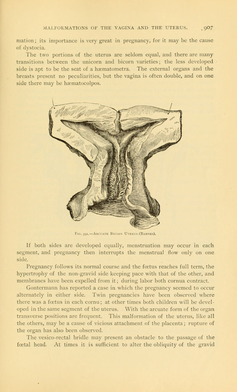 mation ; its importance is very great in pregnancy, for it may be the cause of dystocia. The two portions of the uterus are seldom equal, and there are many transitions between the unicorn and bicorn varieties; the less developed side is apt to be the seat of a hxmatometra. The external organs and the breasts present no peculiarities, but the vagina is often double, and on one side there may be ha>matocolpos. Kig. 591.—Akcl'ate Bicorn Uterus (Barnes). If both sides are developed equally, menstruation may occur in each segment, and pregnancy then interrupts the menstrual flow only on one side. Pregnancy follows its normal course and the foetus reaches full term, the hypertrophy of the non-gravid side keeping pace with that of the other, and membranes have been expelled from it; during labor both cornua contract. Gontermann has reported a case in which the pregnancy seemed to occur alternately in either side. Twin pregnancies have been observed where there was a lotus in each cornu; at other times both children will be devel- oped in the same segment of the uterus. With the arcuate form of the organ transverse positions are frequent. This malformation of the uterus, like all the others, may be a cause of vicious attachment of the placenta; rupture of the organ has also been observed. The vcsico-rectal bridle may present an obstacle to the passage of the foetal head. At times it is sufficient to alter the obliquity of the gravid