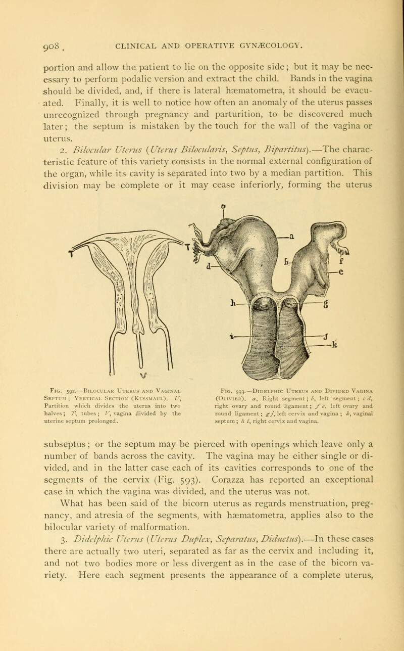 portion and allow the patient to lie on the opposite side; but it may be nec- essary to perform podalic version and extract the child. Bands in the vagina should be divided, and, if there is lateral haematometra, it should be evacu- ated. Finally, it is well to notice how often an anomaly of the uterus passes unrecognized through pregnancy and parturition, to be discovered much later; the septum is mistaken by the touch for the wall of the vagina or uterus. 2. Bilocular Uterus {Uterus Bilocularis, Septus, Bipartitus).—The charac- teristic feature of this variety consists in the normal external configuration of the organ, while its cavity is separated into two by a median partition. This division may be complete or it may cease inferiorly, forming the uterus Fig. 592.—Bilocular Uteris and Vaginal Septum ; Vertical Section (Kussmaul). l\ Partition which divides the uterus into two halves; 7, tubes; J\ vagina divided by the uterine septum prolonged. Fig. 593.—Didelphic Uterus and Divided Vagina (Olivier), a. Right segment;/', left segment; cd, right ovary and round ligament ; / e, left ovary and round ligament; gj\ left cervix and vagina ; k, vaginal septum ; /; i, right cervix and vagina. subseptus; or the septum may be pierced with openings which leave only a number of bands across the cavity. The vagina may be either single or di- vided, and in the latter case each of its cavities corresponds to one of the segments of the cervix (Fig. 593). Corazza has reported an exceptional case in which the vagina was divided, and the uterus was not. What has been said of the bicorn uterus as regards menstruation, preg- nancy, and atresia of the segments, with hoematometra, applies also to the bilocular variety of malformation. 3. Didelphic Uterus (Uterus Duplex, Separatus, DiJuctus).—In these cases there are actually two uteri, separated as far as the cervix and including it, and not two bodies more or less divergent as in the case of the bicorn va- riety. Here each segment presents the appearance of a complete uterus,