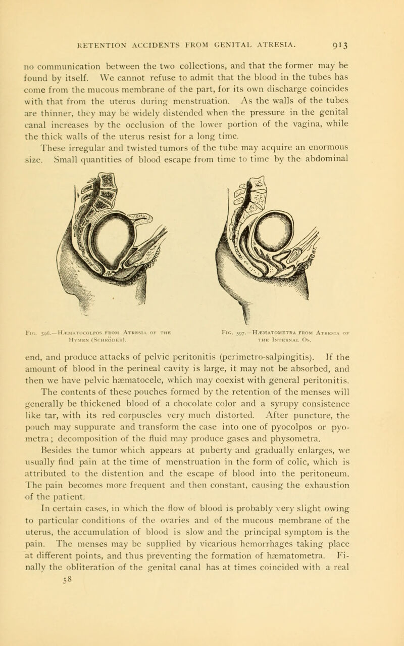 no communication between the two collections, and that the former may be found by itself. We cannot refuse to admit that the blood in the tubes has come from the mucous membrane of the part, for its own discharge coincides with that from the uterus during menstruation. As the walls of the tubes are thinner, they may be widely distended when the pressure in the genital canal increases by the occlusion of the lower portion of the vagina, while the thick walls of the uterus resist for a long time. These irregular and twisted tumors of the tube may acquire an enormous size. Small quantities of blood escape from time to time by the abdominal 1 ;, .>. llijuiuuiLriis from Atresia of the II', men 1 Schroder). FlG. 597.- H.F.MATOMETRA FROM ATRESIA OF THE Internal Os. end, and produce attacks of pelvic peritonitis (perimetro-salpingitis). If the amount of blood in the perineal cavity is large, it may not be absorbed, and then we have pelvic hematocele, which ma)- coexist with general peritonitis. The contents of these pouches formed by the retention of the menses will generally be thickened blood of a chocolate color and a syrupy consistence like tar, with its red corpuscles very much distorted. After puncture, the pouch may suppurate and transform the case into one of pyocolpos or pyo- metra; decomposition of the fluid may produce gases and physometia. Besides the tumor which appears at puberty and gradually enlarges, wc usually find pain at the time of menstruation in the form of colic, which is attributed to the distention and the escape of blood into the peritoneum. The pain becomes more frequent and then constant, causing the exhaustion of the patient. In certain cases, in which the flow of blood is probably very slight owing to particular conditions of the ovaries and of the mucous membrane of the uterus, the accumulation of blood is slow and the principal symptom is the pain. The menses may be supplied by vicarious hemorrhages taking place at different points, and thus preventing the formation of haematometra. Fi- nally the obliteration of the genital canal has at times coincided with a real 58