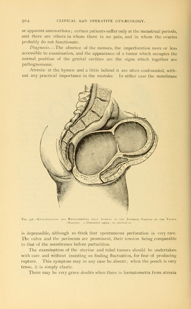 or apparent amenorrhqea; certain patients suffer only at the menstrual periods, and there are others in whom there is no pain, and in whom the ovaries probably do not functionate. Diagnosis.—The absence of the menses, the imperforation more or less accessible to examination, and the appearance of a tumor which occupies the normal position of the genital cavities are the signs which together are pathognomonic. Atresia; at the hymen and a little behind it are often confounded, with- out any practical importance in the mistake. In either case the membrane Fig. 598.—H-ematocolpos and Hjematometra prom Atresia of the Inferior Portion of the Vagina 1 Barnes). ~\ Distended vagina; <>«, internal os. is depressible, although so thick that spontaneous perforation is very rare. The vulva and the perineum are prominent, their tension being comparable to that of the membranes before parturition. The examination of the uterine and tubal tumors should be undertaken with care and without insisting on finding fluctuation, for fear of producing rupture. This symptom may in anv case be absent; when the pouch is very tense, it is simply elastic. There may be very grave doubts when there is luematometra from atresia