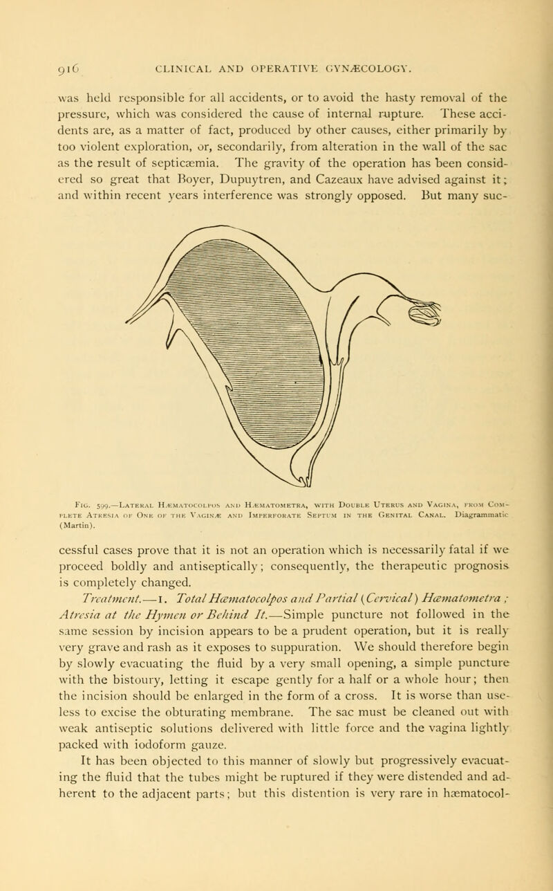 was held responsible for all accidents, or to avoid the hasty removal of the pressure, which was considered the cause of internal rupture. These acci- dents are, as a matter of fact, produced by other causes, either primarily by too violent exploration, or, secondarily, from alteration in the wall of the sac as the result of septicaemia. The gravity of the operation has been consid- ered so great that Koyer, Dupuytren, and Cazeaux have advised against it; and within recent years interference was strongly opposed. But many suc- Fig. 599.—Lateral H.ematocolpos and H^ematometra, with Double Uterus and Vagina, from Com- plete Atresia of One of the VagiNjB and Imperforate Septum IN the Genital Canal. Diagrammatic (Martin). cessful cases prove that it is not an operation which is necessarily fatal if we proceed boldly and antiseptically; consequently, the therapeutic prognosis is completely changed. Treatment. —■ I. Total Hcematocolpos and Partial (Cervical) Hcematometra ; Atresia at the Hymen or Behind It.—Simple puncture not followed in the same session by incision appears to be a prudent operation, but it is really very grave and rash as it exposes to suppuration. We should therefore begin by slowly evacuating the fluid by a very small opening, a simple puncture with the bistoury, letting it escape gently for a half or a whole hour; then the incision should be enlarged in the form of a cross. It is worse than use- less to excise the obturating membrane. The sac must be cleaned out with weak antiseptic solutions delivered with little force and the vagina lightly packed with iodoform gauze. It has been objected to this manner of slowly but progressively evacuat- ing the fluid that the tubes might be ruptured if they were distended and ad- herent to the adjacent parts; but this distention is very rare in hoematocol-