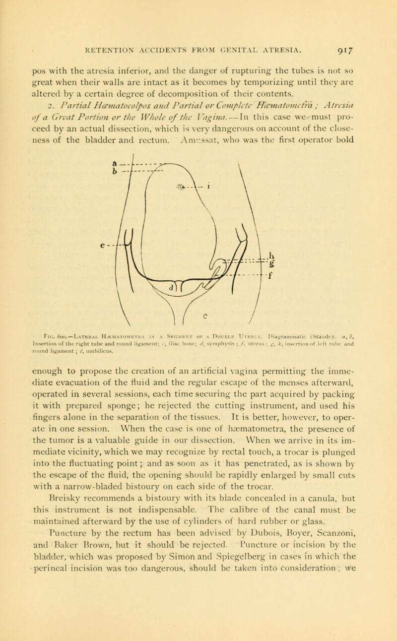 pos with the atresia inferior, and the danger of rupturing the tubes is not so great when their walls are intact as it becomes by temporizing until they are altered by a certain degree of decomposition of their contents. 2. Partial Hcematocolpos and Partial or Complete Hicmatoiititra ; Atresia of a Great Portion-or the Whole of the Vagina. — In this case we must pro- ceed by an actual dissection, which is very dangerous on account of the close- ness of the bladder and rectum. Amussat, who was the first operator bold Fig. 600.—Lateral HjSMatometka in \ Segment op \ Double Uterus. Diagrammatic (Staude). a, i, Insertion of the right tube and round Ligament; <, iliac hone; ,/\ symphysis ; /. uterus ; g*t //, insertion of left tube and round ligament ; /, umbilicus. enough to propose the creation of an artificial vagina permitting the imme- diate evacuation of the fluid and the regular escape of the menses afterward, operated in several sessions, each time securing the part acquired by packing it with prepared sponge; he rejected the cutting instrument, and used his fingers alone in the separation of the tissues. It is better, however, to oper- ate in one session. When the ease is one of haematometra, the presence of the tumor is a valuable guide in our dissection. When we arrive in its im- mediate vicinity, which we may recognize by rectal touch, a trocar is plunged into the fluctuating point; and as soon as it has penetrated, as is shown by the escape of the fluid, the opening should be rapidly enlarged by small cuts with a narrow-bladed bistoury on each side of the trocar. Breisky recommends a bistoury with its blade concealed in a canula, but this instrument is not indispensable. The calibre of the canal must be maintained afterward by the use of cylinders of hard rubber or glass. Puncture by the rectum has been advised by Dubois, Hoyer, Scanzoni, and Baker Brown, but it should be rejected. Puncture or incision by the bladder, which was proposed by -Simon and Spiegelberg in cases in which the perineal incision was too dangerous, should be taken into consideration ; we