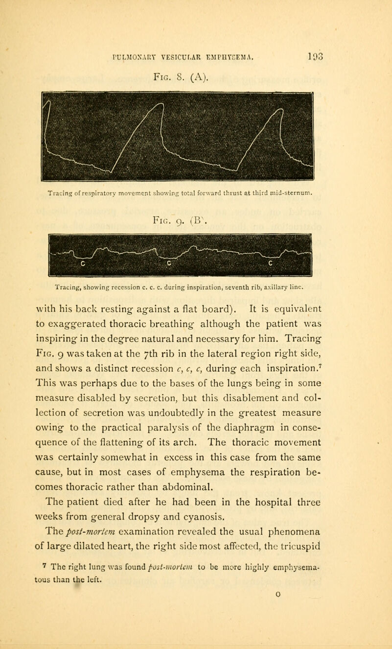 Fig. S. (A). Tracing of respiratory movement showing total forward thrust at third mid-sternum Fig. 9. (B Tracing, showing recession c. c. c. during inspiration, seventh rib, axillary line. with his back resting- against a flat board). It is equivalent to exaggerated thoracic breathing although the patient was inspiring in the degree natural and necessary for him. Tracing Fig. 9 was taken at the 7th rib in the lateral region right side, and shows a distinct recession c, c, c, during each inspiration.7 This was perhaps due to the bases of the lungs being in some measure disabled by secretion, but this disablement and col- lection of secretion was undoubtedly in the greatest measure owing to the practical paralysis of the diaphragm in conse- quence of the flattening of its arch. The thoracic movement was certainly somewhat in excess in this case from the same cause, but in most cases of emphysema the respiration be- comes thoracic rather than abdominal. The patient died after he had been in the hospital three weeks from general dropsy and cyanosis. The post-viortem examination revealed the usual phenomena of large dilated heart, the right side most affected, the tricuspid 7 The right lung was found post-mortem to be more highly emphysema- tous than the left. 0