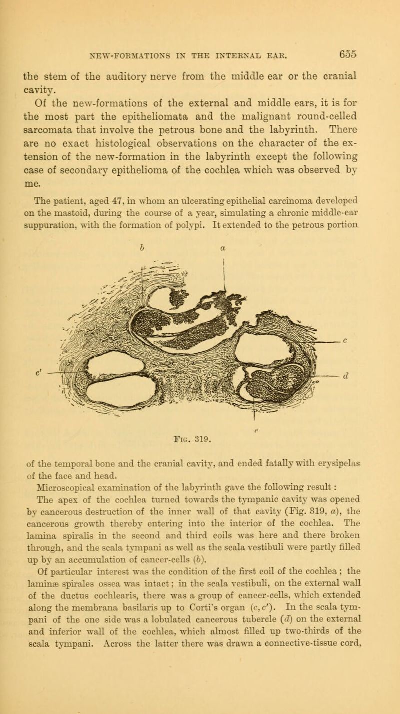 the stem of the auditory nerve from the middle ear or the cranial cavity. Of the new-formations of the external and middle ears, it is for the most part the epitheliomata and the malignant round-celled sarcomata that involve the petrous bone and the labyrinth. There are no exact histological observations on the character of the ex- tension of the new-formation in the labyrinth except the following case of secondary epithelioma of the cochlea which was observed by me. The patient, aged 47. in whom an ulcerating epithelial carcinoma developed on the mastoid, during the course of a year, simulating a chronic middle-ear suppuration, with the formation of polypi. It extended to the petrous portion Fig. 319. of the temporal bone and the cranial cavity, and ended fatally with erysipelas of the face and head. Microscopical examination of the labyrinth gave the following result : The apex of the cochlea turned towards the tympanic cavity was opened bv cancerous destruction of the inner wall of that cavity (Fig. 319, a), the cancerous growth thereby entering into the interior of the cochlea. The lamina spiralis in the second and third coils was here and there broken through, and the scala tympani as well as the scala vestibuli were partly rilled up by an accumulation of cancer-cells (6). Of particular interest was the condition of the first coil of the cochlea : the lamime spirales ossea was intact: in the scala vestibuli, on the external wall of the ductus cochlearis, there was a group of cancer-cells, which extended along the membrana basilaris up to Corti's organ {c.c'). In the scala tym- pani of the one side was a lobulated cancerous tubercle (<f) on the external and inferior wall of the cochlea, which almost filled up two-thirds of the scala tympani. Across the latter there was drawn a connective-tissue cord.