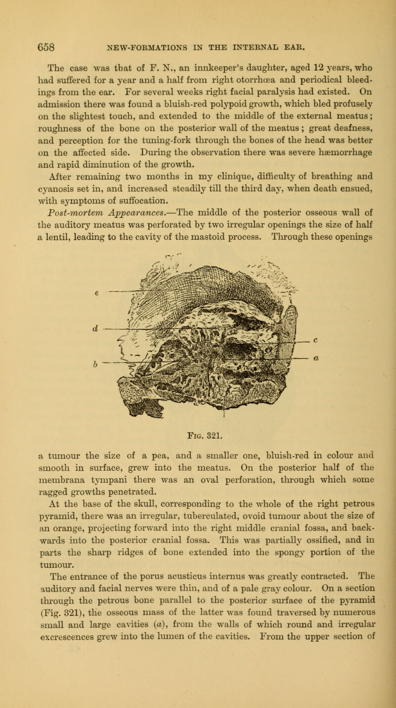 The case was that of F. N., an innkeeper's daughter, aged 12 years, who had suffered for a year and a half from right otorrhoea and periodical bleed- ings from the ear. For several weeks right facial paralysis had existed. On admission there was found a bluish-red polypoid growth, which bled profusely on the slightest touch, and extended to the middle of the external meatus; roughness of the bone on the posterior wall of the meatus ; great deafness, and perception for the tuning-fork through the bones of the head was better on the affected side. During the observation there was severe haemorrhage and rapid diminution of the growth. After remaining two months in my clinique, difficult}* of breathing and cyanosis set in, and increased steadily till the third day, when death ensued, with symptoms of suffocation. Post-mortem Appearances.—The middle of the posterior osseous wall of the auditory meatus was perforated by two irregular openings the size of half a lentil, leading to the cavity of the mastoid process. Through these openings Fig. 321. a tumour the size of a pea, and a smaller one, bluish-red in colour and smooth in surface, grew into the meatus. On the posterior half of the membrana tympani there was an oval perforation, through which some ragged growths penetrated. At the base of the skull, corresponding to the whole of the right petrous pyramid, there was an irregular, tuberculated, ovoid tumour about the size of an orange, projecting forward into the right middle cranial fossa, and back- wards into the posterior cranial fossa. This was partially ossified, and in parts the sharp ridges of bone extended into the spongy portion of the tumour. The entrance of the porus acusticus internus was greatly contracted. The auditory and facial nerves were thin, and of a pale gray colour. On a section through the petrous bone parallel to the posterior surface of the pyramid (Fig. 321), the osseous mass of the latter was found traversed by numerous small and large cavities (a), from the walls of which round and irregular excrescences grew into the lumen of the cavities. From the upper section of