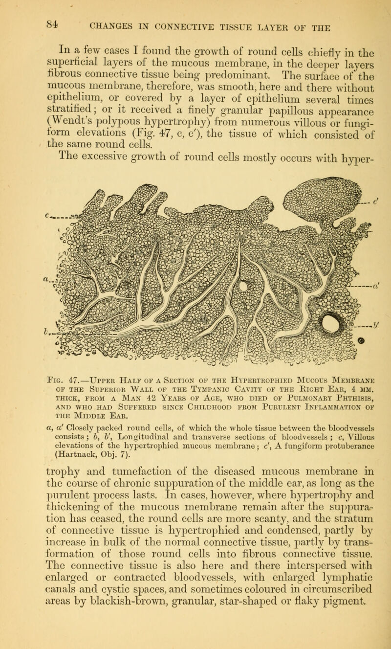 In a few cases I found the growth of round cells chiefly in the superficial layers of the mucous membrane, in the deeper layers fibrous connective tissue being predominant. The surface of the mucous membrane, therefore, was smooth, here and there without epithelium, or covered by a layer of epithelium several times stratified; or it received a finely granular papulous appearance (Wendt's polypous hypertrophy) from numerous villous or fungi- form elevations (Fig. 47, c, c'), the tissue of which consisted of the same round cells. The excessive growth of round cells mostly occurs with hyper- Fig. 47.—Upper Half of a Section of the Hypertrophied Mucous Membrane of the Superior Wall of the Tympanic Cavity of the Eight Ear, 4 mm. thick, from a man 42 years of age, who died of pulmonary phthisis, and who had suffered since childhood from purulent inflammation of the Middle Ear. a, a' Closely packed round cells, of which the whole tissue between the bloodvessels consists; b, b', Longitudinal and transverse sections of bloodvessels ; c, Villous elevations of the hypertrophied mucous membrane; c', A fungiform protuberance (Hartnack, Obj. 7). trophy and tumefaction of the diseased mucous membrane in the course of chronic suppuration of the middle ear, as long as the purulent process lasts. In cases, however, where hypertrophy and thickening of the mucous membrane remain after the suppura- tion has ceased, the round cells are more scanty, and the stratum of connective tissue is hypertrophied and condensed, partly by increase in bulk of the normal connective tissue, partly by trans- formation of those round cells into fibrous connective tissue. The connective tissue is also here and there interspersed with enlarged or contracted bloodvessels, with enlarged lymphatic canals and cystic spaces, and sometimes coloured in circumscribed areas by blackish-brown, granular, star-shaped or flaky pigment.