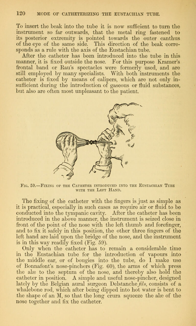 To insert the beak into the tube it is now sufficient to turn the instrument so far outwards, that the metal ring fastened to its posterior extremity is pointed towards the outer canthus of the eye of the same side. This direction of the beak corre- sponds as a rule with the axis of the Eustachian tube. After the catheter has been introduced into the tube in this manner, it is fixed outside the nose. For this purpose Kramer's frontal band or Kau's spectacles were formerly used, and are still employed by many specialists. With both instruments the catheter is fixed by means of calipers, which are not only in- sufficient during the introduction of gaseous or fluid substances, but also are often most unpleasant to the patient. S^^^N-, Fig. 59. -Fixing of the Catheter introduced into the Eustachian Tube with the Left Hand. The fixing of the catheter with the fingers is just as simple as it is practical, especially in such cases as require air or fluid to be conducted into the tympanic cavity. After the catheter has been introduced in the above manner, the instrument is seized close in front of the point of the nose with the left thumb and forefinger, and to fix it safely in this position, the other three fingers of the left hand are laid upon the bridge of the nose, and the instrument is in this way readily fixed (Fig. 59). Only when the catheter has to remain a considerable time in the Eustachian tube for the introduction of vapours into the middle ear, or of bougies into the tube, do I make use of Bonnafont's nose-pinchers (Fig. 60), the arms of which press the alas to the septum of the nose, and thereby also hold the catheter in position. A simple and useful nose-pincher, designed lately by the Belgian aural surgeon Delstanche/i/.s, consists of a Avhalebone rod, which after being dipped into hot water is bent to the shape of an M, so that the long crura squeeze the aire of the nose together and fix the catheter.