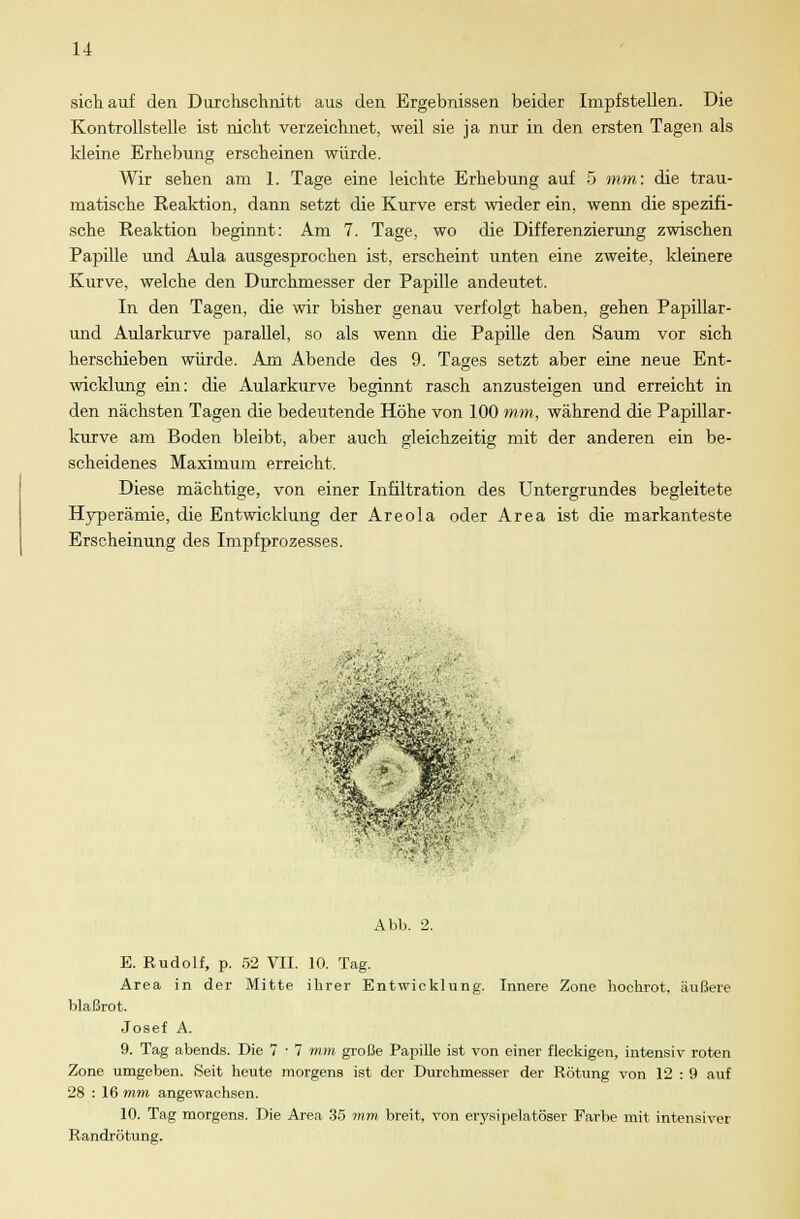 sich auf dea Durchschnitt aus den Ergebnissen beider Impfstellen. Die Kontrollstelle ist nicht verzeichnet, weil sie ja nur in den ersten Tagen als kleine Erhebung erscheinen würde. Wir sehen am 1. Tage eine leichte Erhebung auf 5 mm: die trau- matische Eeaktion, dann setzt die Kurve erst wieder ein, wenn die spezifi- sche Reaktion beginnt: Am 7. Tage, wo die Differenzierung zwischen Papille und Aula ausgesprochen ist, erscheint unten eine zweite, kleinere Kurve, welche den Durchmesser der Papille andeutet. In den Tagen, die wir bisher genau verfolgt haben, gehen Papillar- und Aularkurve parallel, so als wenn die Papille den Saum vor sich herschieben würde. Am Abende des 9. Tages setzt aber eine neue Ent- wicklung ein: die Aularkurve beginnt rasch anzusteigen und erreicht in den nächsten Tagen die bedeutende Höhe von 100 mm, während die Papillär - kurve am Boden bleibt, aber auch gleichzeitig mit der anderen ein be- scheidenes Maximum erreicht. Diese mächtige, von einer Infiltration des Untergrundes begleitete Hyperämie, die Entwicklung der Areola oder Area ist die markanteste Erscheinung des Impfprozesses. ;4 Abb. 2. E. Rudolf, p. 52 VII. 10. Tag. Area in der Mitte ihrer Entwicklung. Innere Zone hochrot, äußere blaßrot. Josef A. 9. Tag abends. Die 7 •- 7 mm große Papille ist von einer fleckigen, intensiv roten Zone umgeben. Seit heute morgens ist der Durchmesser der Rötung von 12 : 9 auf 28 : 16 mm angewachsen. 10. Tag morgens. Die Area 35 mm breit, von erysipelatöser Farbe mit intensiver Randrötung.