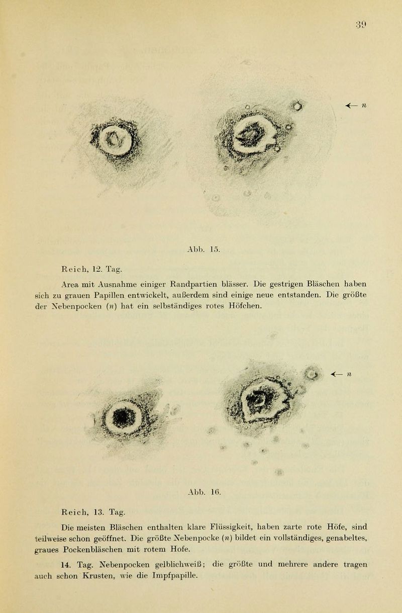 -<— n Abb. 15. Reich, 12. Tag. Area mit Ausnahme einiger Randpartien blasser. Die gestrigen Bläschen haben sich zu grauen Papillen entwickelt, außerdem sind einige neue entstanden. Die größte der Xebenpocken (») hat ein selbständiges rotes Höfchen. > <- i Abb. 16. Reich, 13. Tag. Die meisten Bläschen enthalten klare Flüssigkeit, haben zarte rote Höfe, sind teilweise schon geöffnet. Die größte Nebenpocke (n) bildet ein vollständiges, genabeltes, graues Pockenbläschen mit rotem Hofe. 14. Tag. Xebenpocken gel blich weiß; die größte und mehrere andere tragen auch schon Krusten, wie die Impfpapille.