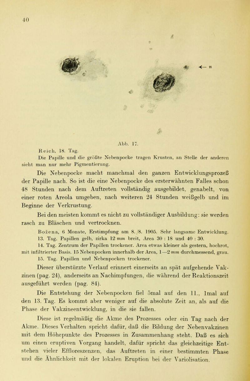m -<— n Abb. 17. Reich. 18. Tag. Die Papille und die größte Nebenpocke tragen Krusten, an Stelle der anderen sieht man nur mehr Pigmentierung. Die Nebenpocke macht manchmal den ganzen Entwicklungsprozeß der Papille nach. So ist die eine Nebenpocke des ersterwähnten Falles schon 48 Stunden nach dem Auftreten vollständig ausgebildet, genabelt, von einer roten Areola umgeben, nach weiteren 24 Stunden weißgelb und im Beginne der Verkrustung. Bei den meisten kommt es nicht zu vollständiger Ausbildung: sie werden rasch zu Bläschen und vertrocknen. Bozena, 6 Monat«, Erstimpfung am 8./8. 1905. Sehr langsame Entwicklung. 13. Tag. Papillen gelb, zirka 12 mm breit, Area 30 : 18 und 40 : 30. 14. Tag. Zentrum der Papillen trockener. Area etwas kleiner als gestern, hochrot, mit infiltrierter Basis. 15 Nebenpocken innerhalb der Area, 1—2 mm durchmessend, grau. 15. Tag. Papillen und Nebenpocken trockener. Dieser überstürzte Verlauf erinnert einerseits an spät aufgehende Vak- zinen (pag. 24), anderseits an Nachimpfungen, die während der Reaktionszeit ausgeführt werden (pag. 84). Die Entstehung der Nebenpocken fiel ömal auf den IL. lmal auf den 13. Tag. Es kommt aber weniger auf die absolute Zeit an, als auf die Phase der Vakzineentwicklung, in die sie fallen. Diese ist regelmäßig die Akme des Prozesses oder ein Tag nach der Akme. Dieses Verhalten spricht dafür, daß die Bildung der Nebenvakzinen mit dem Höhepunkte des Prozesses in Zusammenhang steht. Daß es sich um einen eruptiven Vorgang handelt, dafür spricht das gleichzeitige Ent- stehen vieler Effloreszenzen, das Auftreten in einer bestimmten Phase und die Ähnlichkeit mit der lokalen Eruption bei der Variolisation.