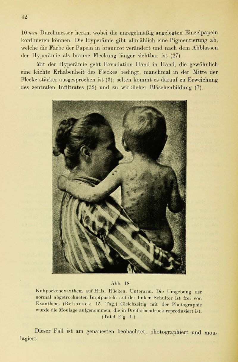 10 mm Durchmesser heran, wobei die unregelmäßig angelegten Einzelpapeln konfluieren können. Die Hyperämie gibt allmählich eine Pigmentierung ab, welche die Farbe der Papeln in braunrot verändert und nach dem Abblassen der Hyperämie als braune Fleckung länger sichtbar ist (27). Mit der Hyperämie geht Exsudation Hand in Hand, die gewöhnlich eine leichte Erhabenheit des Fleckes bedingt, manchmal in der Mitte der Flecke stärker ausgesprochen ist (3); selten kommt es darauf zu Erweichung des zentralen Infiltrates (32) und zu wirklicher Bläschenbildung (7). Abi). 18. Kuhpockenexaithem auf Hals, Rücken, Unterarm. Die Umgebung der normal abgetrockneten Impfpusteln auf der linken Schulter ist frei von Exanthem. (Rehousek, 15. Tag.) Gleichzeitig mit der Photographie wurde die Moulage aufgenommen, die in Dreifarbendruck reproduziert ist. (Tafel Fig. 1.) lagiert. Dieser Fall ist am genauesten beobachtet, photographiert und mou-