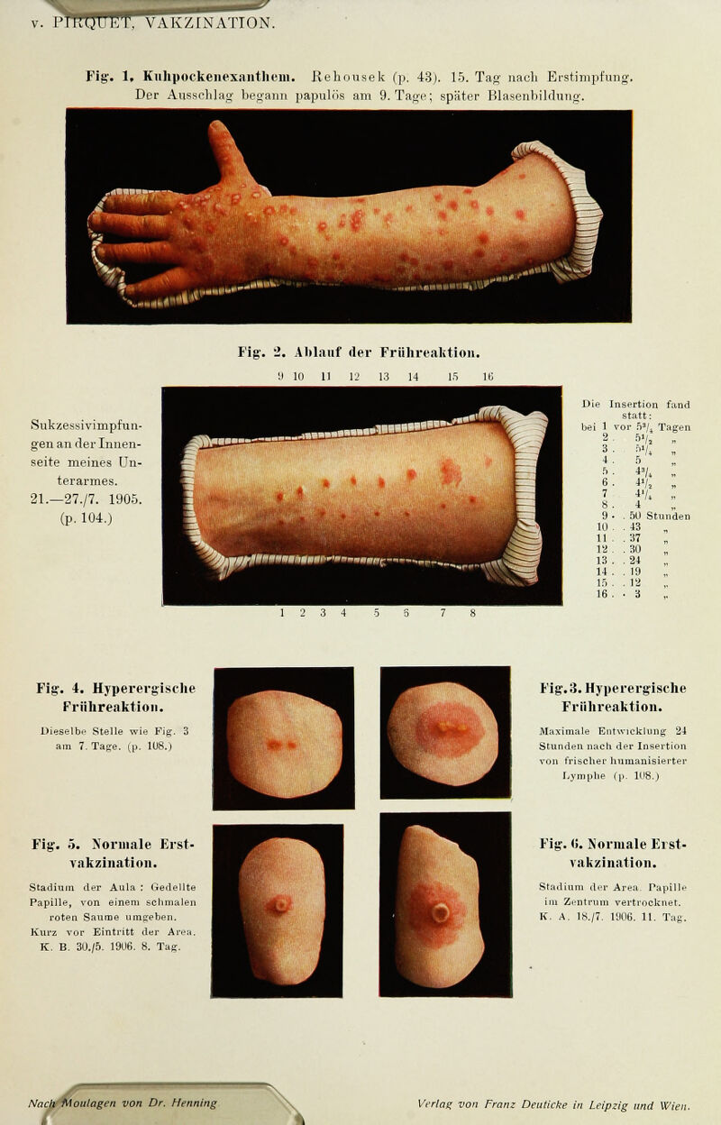 Der Ausschlag begann papulös am 9. Tage; später Blasenbildung. Sukzessivimpfun- gen an der Innen- seite meines Un- terarmes. 21.—27./7. 1905. (p. 104.) Fig. 2. Ablauf der Frühreaktion. 'J 10 11 12 13 14 15 16 Die Insertion fand statt: bei 1 vor n3/^ Tagen 2 Sa/2 , 3 hlU „ 4 5 ft i3U „ 6 . i'l ,. 7 i'l „ 8 4 9 . . 5U Stunden 1U ■ 43 11 • 37 12 • 30 13 ■ • 24 14 • 19 15 . 18 16 • 3 Fig. 4. Hyperergische Frühreaktion. Dieselbe Stelle wie Fig. 3 am 7. Tage. (p. 11)8.) Fig. 5. Normale Erst- vakzination. Stadium der Aula : Gedellte Papille, von einem schmalen roten Saume umgeben. Kurz vor Eintritt der Area. K. B. 30./5. 1906. 8. Tag. Fig. 3. Hyperergische Frühreaktion. Maximale Entwicklung 24 Stunden nach der Insertion von frischer humanisierter Lymphe (p. 108.) Fig. (>. Normale Erst- vakzination. Stadium der Area. Papille im Zentrum vertrocknet. K. A. 18./7. 1906. 11. Tag. Nach Moulagen von Dr. Henning Verlag von Franz Deuticke in Leipzig und Wien.