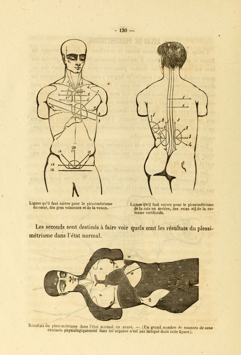 Lignes qu'il faut suivre pour le plessimélrisme du cœur, des gros vaisseaux et de la vessie. Lignes qu'il faut suivre pour le plessimétrisme de la raie en arrière, des reins et} de la co- lonne vertébrale. Les seconds sont destinés à faire voir quels sont les résultats du plessi- métrisme dans l'état normal. Rt'sullalsdu plessimétrigme dans l'état normal en avant. - (Un grand nombre de nuances de sons existants pbysiologiquement dans les organes n'est pas indiqué dans celle figure).