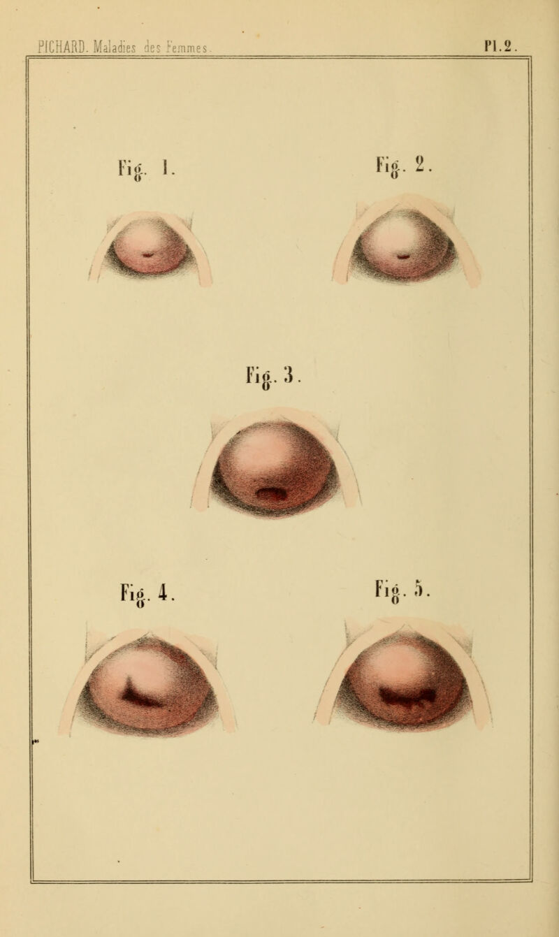 PICHARD. Maladies des Femmes PI.2