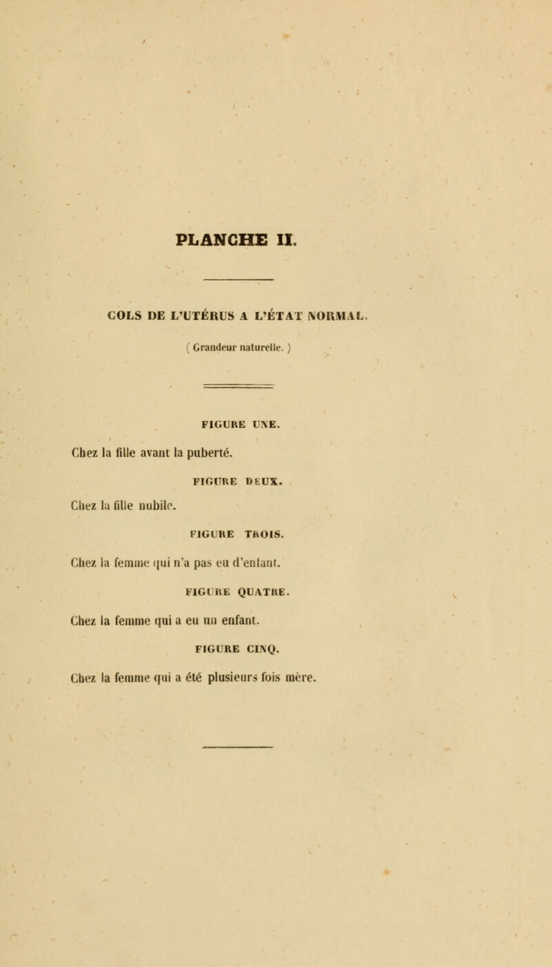 COLS DE L'UTÉRUS A L'ÉTAT NORMAL. ( Grandeur naturelle. ) FIGURE U\E. Chez la fille avant la puberté. FIGURE DfcUX. Chez la fille nubile. FIGURE TROIS. Chez la femme qui n'a pas eu (reniant. FIGURE QUATRE. Chez la femme qui a eu ou enfant. FIGURE CIIVQ. Chez la femme qui a été plusieurs fois mère.