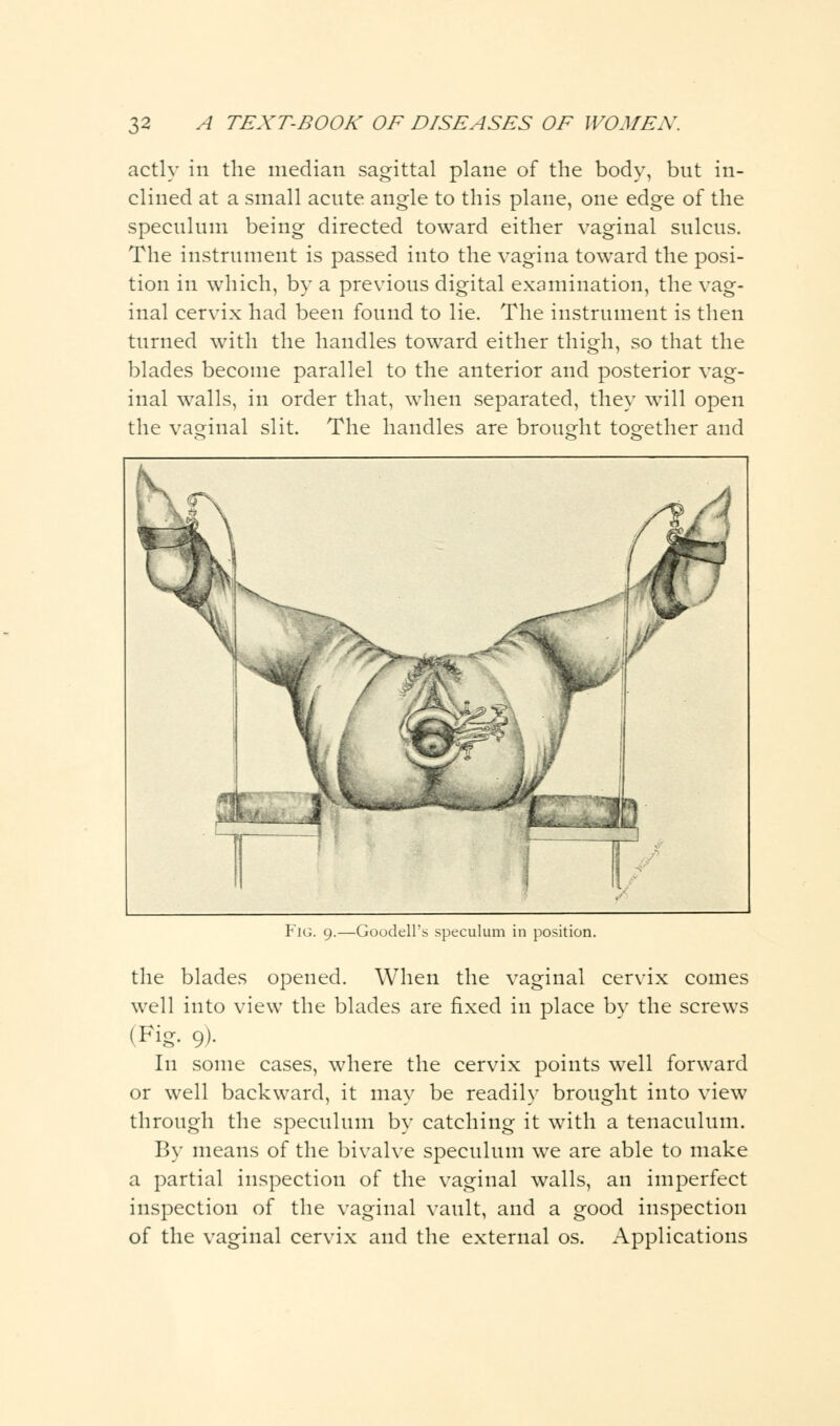 actly in the median sagittal plane of the body, but in- clined at a small acute angle to this plane, one edge of the speculum being directed toward either vaginal sulcus. The instrument is passed into the vagina toward the posi- tion in which, by a previous digital examination, the vag- inal cervix had been found to lie. The instrument is then turned with the handles toward either thigh, so that the blades become parallel to the anterior and posterior vag- inal walls, in order that, when separated, they will open the vaginal slit. The handles are brought together and ■Goodell's speculum in position. the blades opened. When the vaginal cervix comes well into view the blades are fixed in place by the screws (Fig. 9). In some cases, where the cervix points well forward or well backward, it may be readily brought into view through the speculum by catching it with a tenaculum. By means of the bivalve speculum we are able to make a partial inspection of the vaginal walls, an imperfect inspection of the vaginal vault, and a good inspection of the vaginal cervix and the external os. Applications