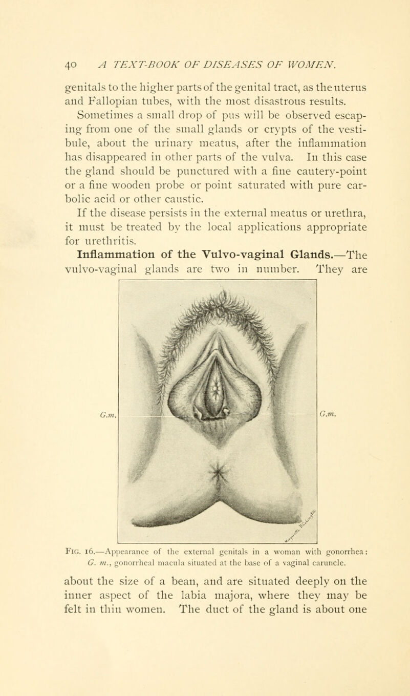 genitals to the higher parts of the genital tract, as the uterus and Fallopian tubes, with the most disastrous results. Sometimes a small drop of pus will be observed escap- ing from one of the small glands or crypts of the vesti- bule, about the urinary meatus, after the inflammation has disappeared in other parts of the vulva. In this case the gland should be punctured with a fine cautery-point or a fine wooden probe or point saturated with pure car- bolic acid or other caustic. If the disease persists in the external meatus or urethra, it must be treated by the local applications appropriate for urethritis. Inflammation of the Vulvo-vaginal Glands.—The vulvo-vaginal glands are two in number. They are G.m. Fig. 16.—Appearance of the external genitals in a woman with gonorrhea: G. m., gonorrheal macula situated at the base of a vaginal caruncle. about the size of a bean, and are situated deeply on the inner aspect of the labia majora, where they may be felt in thin women. The duct of the gland is about one