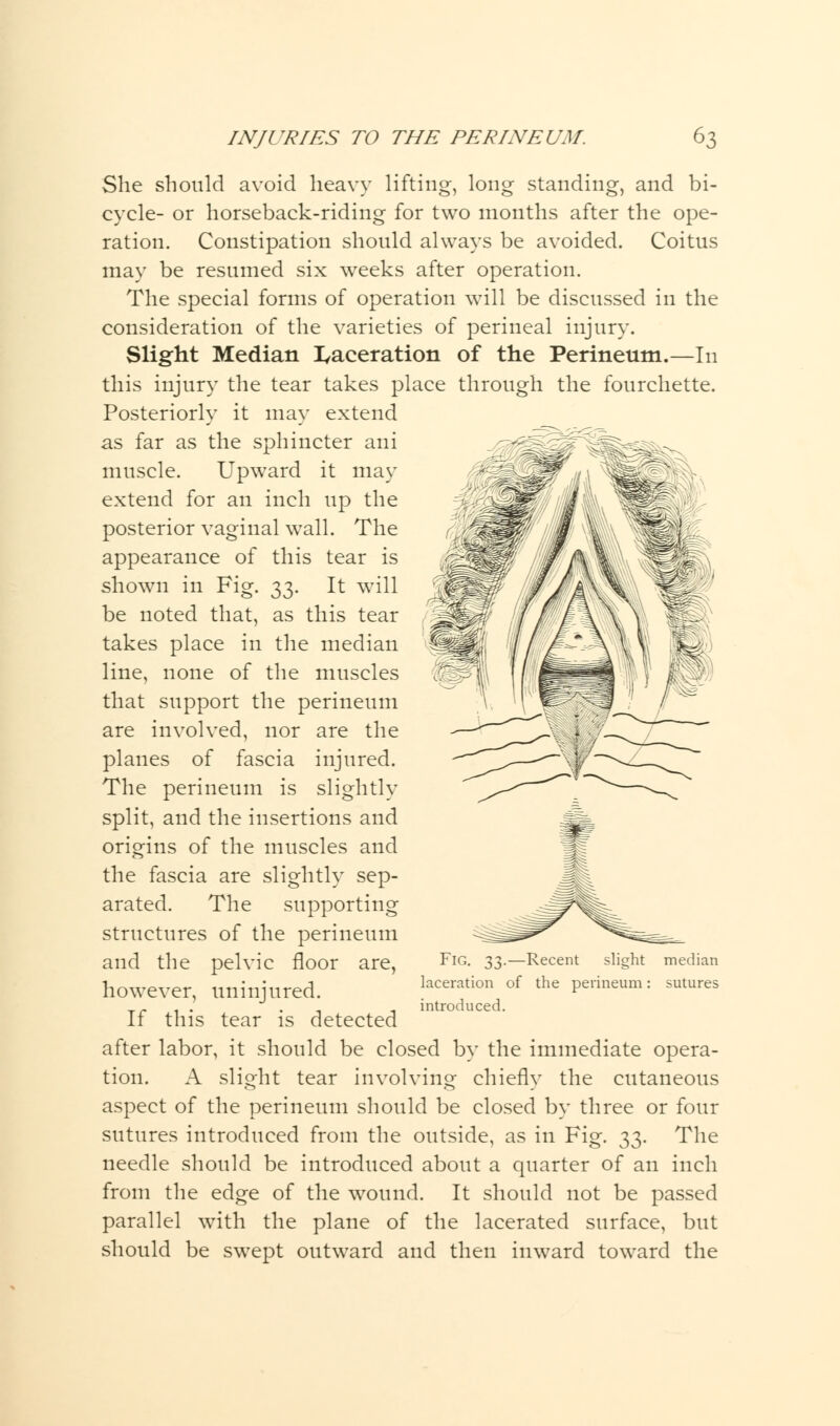 g standing, and bi- She should avoid heavy lifting, Ion cycle- or horseback-riding for two months after the ope- ration. Constipation should always be avoided. Coitus may be resumed six weeks after operation. The special forms of operation will be discussed in the consideration of the varieties of perineal injury. Slight Median laceration of the Perineum.—In this injury the tear takes place through the fourchette. Posteriorly it may extend as far as the sphincter ani muscle. Upward it may extend for an inch up the posterior vaginal wall. The appearance of this tear is shown in Fig. 33. It will be noted that, as this tear takes place in the median line, none of the muscles that support the perineum are involved, nor are the planes of fascia injured. The perineum is slightly split, and the insertions and origins of the muscles and the fascia are slightly sep- arated. The supporting structures of the perineum and the pelvic floor are, however, uninjured. If this tear is detected after labor, it should be closed by the immediate opera- tion. A slight tear involving chiefly the cutaneous aspect of the perineum should be closed by three or four sutures introduced from the outside, as in Fig. 33. The needle should be introduced about a quarter of an inch from the edge of the wound. It should not be passed parallel with the plane of the lacerated surface, but should be swept outward and then inward toward the Fig. 33.—Recent slight median laceration of the perineum introduced. sutures