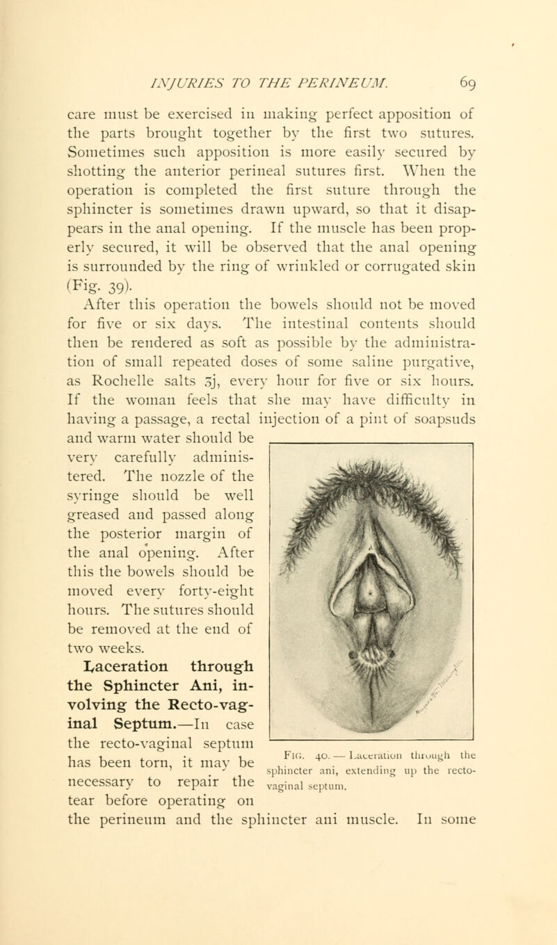 care must be exercised in making perfect apposition of the parts brought together by the first two sutures. Sometimes such apposition is more easily secured by shotting the anterior perineal sutures first. When the operation is completed the first suture through the sphincter is sometimes drawn upward, so that it disap- pears in the anal opening. If the muscle has been prop- erly secured, it will be observed that the anal opening is surrounded by the ring of wrinkled or corrugated skin (Fig. 39)- iVfter this operation the bowels should not be moved for five or six days. The intestinal contents should then be rendered as soft as possible by the administra- tion of small repeated doses of some saline purgative, as Rochelle salts 3J, every hour for five or six hours. If the woman feels that she may have difficulty in having a passage, a rectal injection of a pint of soapsuds and warm water should be very carefully adminis- tered. The nozzle of the syringe should be well greased and passed along the posterior margin of the anal opening. After this the bowels should be moved every forty-eight hours. The sutures should be removed at the end of two weeks. laceration through the Sphincter Ani, in- volving the Recto-vag- inal Septum.—In case the recto-vaginal septum has been torn, it may be necessary to repair the tear before operating on the perineum and the sphincter ani muscle. Fk;. 40. — Laceration through the sphincter ani, extending up the recto- vaginal septum. In some