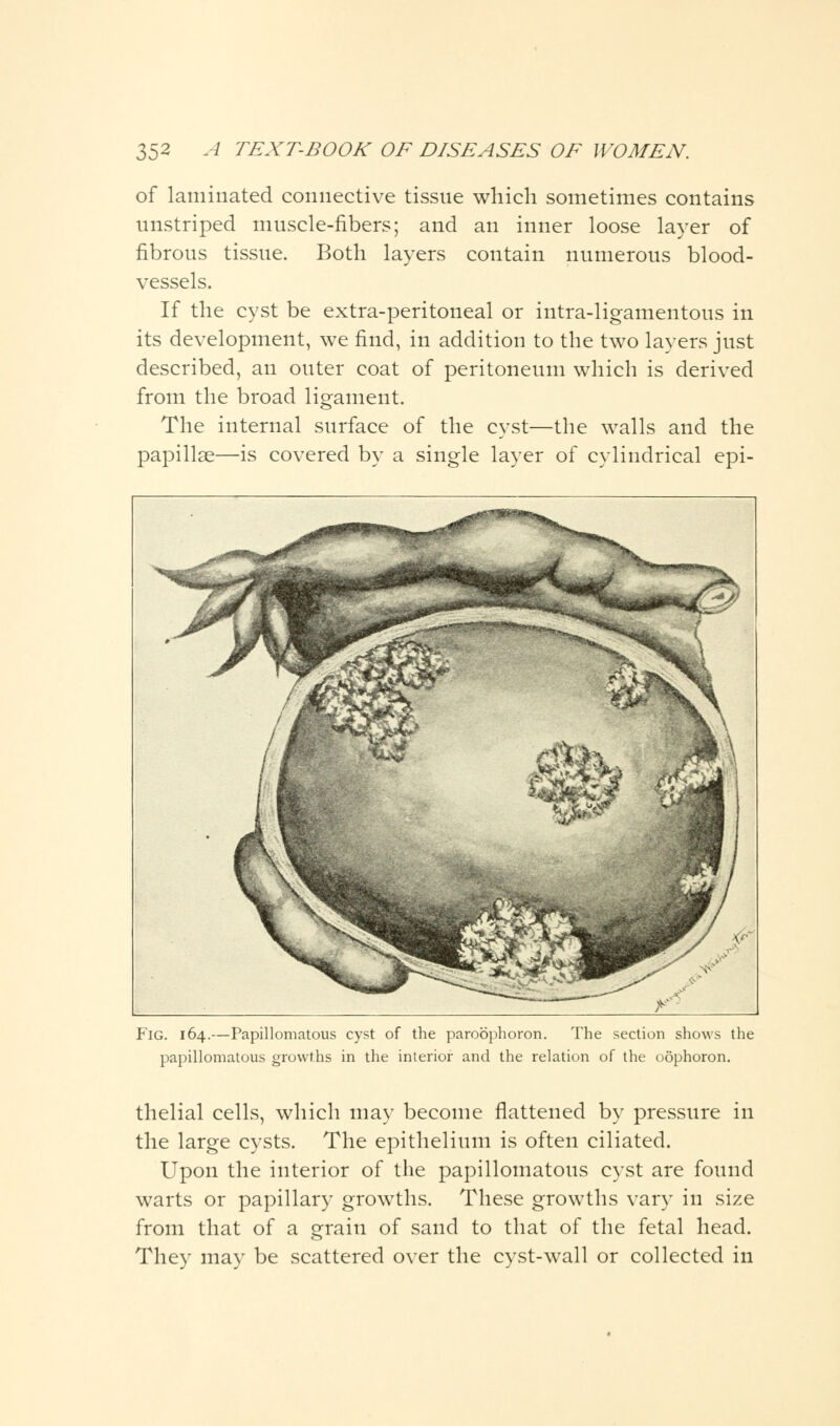 of laminated connective tissue which sometimes contains unstriped muscle-fibers; and an inner loose layer of fibrous tissue. Both layers contain numerous blood- vessels. If the cyst be extra-peritoneal or intra-ligamentous in its development, we find, in addition to the two layers just described, an outer coat of peritoneum which is derived from the broad ligament. The internal surface of the cyst—the walls and the papillae—is covered by a single layer of cylindrical epi- F'ig. 164.—Papillomatous cyst of the paroophoron. The section shows the papillomatous growths in the interior and the relation of the oophoron. thelial cells, which may become flattened by pressure in the large cysts. The epithelium is often ciliated. Upon the interior of the papillomatous cyst are found warts or papillary growths. These growths vary in size from that of a grain of sand to that of the fetal head. They may be scattered over the cyst-wall or collected in