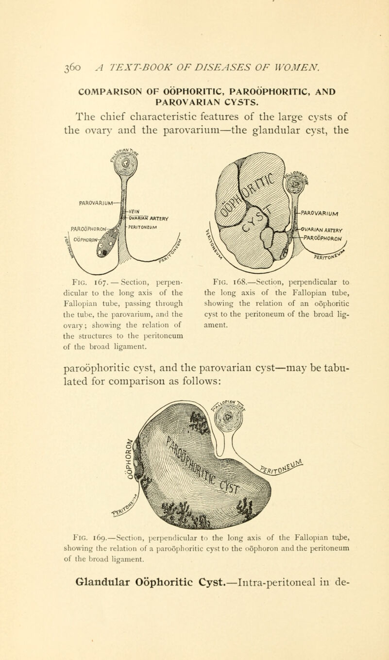 COMPARISON OF OOPHORITIC, PAROOPHORITIC, AND PAROVARIAN CYSTS. The chief characteristic features of the large cysts of the ovary and the parovarium—the glandular cyst, the oj£5L&, Fig. 167. — Section, perpen- dicular to the long axis of the Fallopian tube, passing through the tube, the parovarium, and the ovary; showing the relation of the structures to the peritoneum of the broad ligament. Fig. 168.—Section, perpendicular to the long axis of the Fallopian tube, showing the relation of an oophoritic cyst to the peritoneum of the broad lig- ament. paroophoritic cyst, and the parovarian cyst—may be tabu- lated for comparison as follows: Fig. 169.—Section, perpendicular to the long axis of the Fallopian tube, showing the relation of a paroophoritic cyst to the oophoron and the peritoneum of the broad ligament. Glandular Oophoritic Cyst.—Iutra-peritoneal in de-