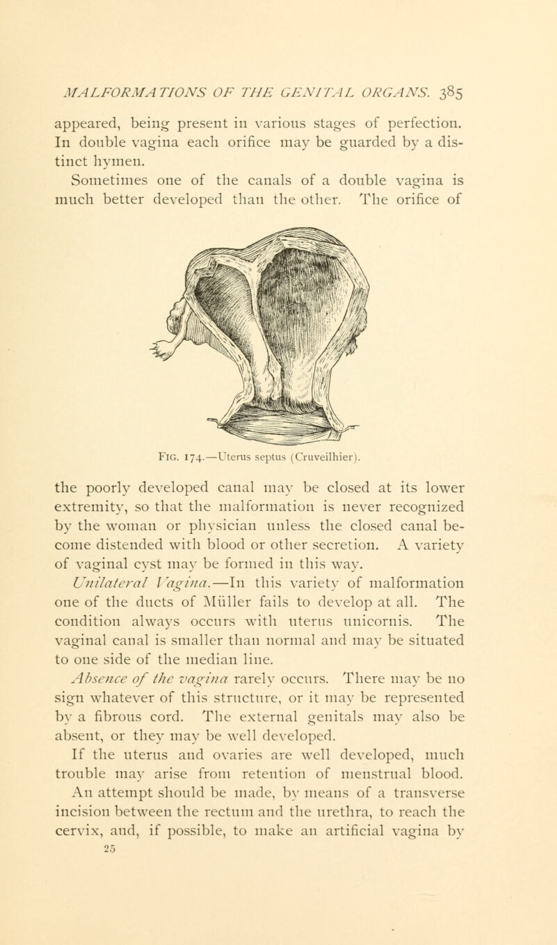 appeared, being present in various stages of perfection. In double vagina each orifice may be guarded by a dis- tinct hymen. Sometimes one of the canals of a double vagina is much better developed than the other. The orifice of Fig. 174.—Uterus septus (Cruveilhier) the poorly developed canal may be closed at its lower extremity, so that the malformation is never recognized by the woman or physician unless the closed canal be- come distended with blood or other secretion. A variety of vaginal cyst may be formed in this way. Unilateral Vagina.—In this variety of malformation one of the ducts of Muller fails to develop at all. The condition always occurs with uterus unicornis. The vaginal canal is smaller than normal and may be situated to one side of the median line. Absence of the vagina rarelv occurs. There may be no sign whatever of this structure, or it may be represented by a fibrous cord. The external genitals may also be absent, or they may be well developed. If the uterus and ovaries are well developed, much trouble may arise from retention of menstrual blood. An attempt should be made, by means of a transverse incision between the rectum and the urethra, to reach the cervix, and, if possible, to make an artificial vagina by 25